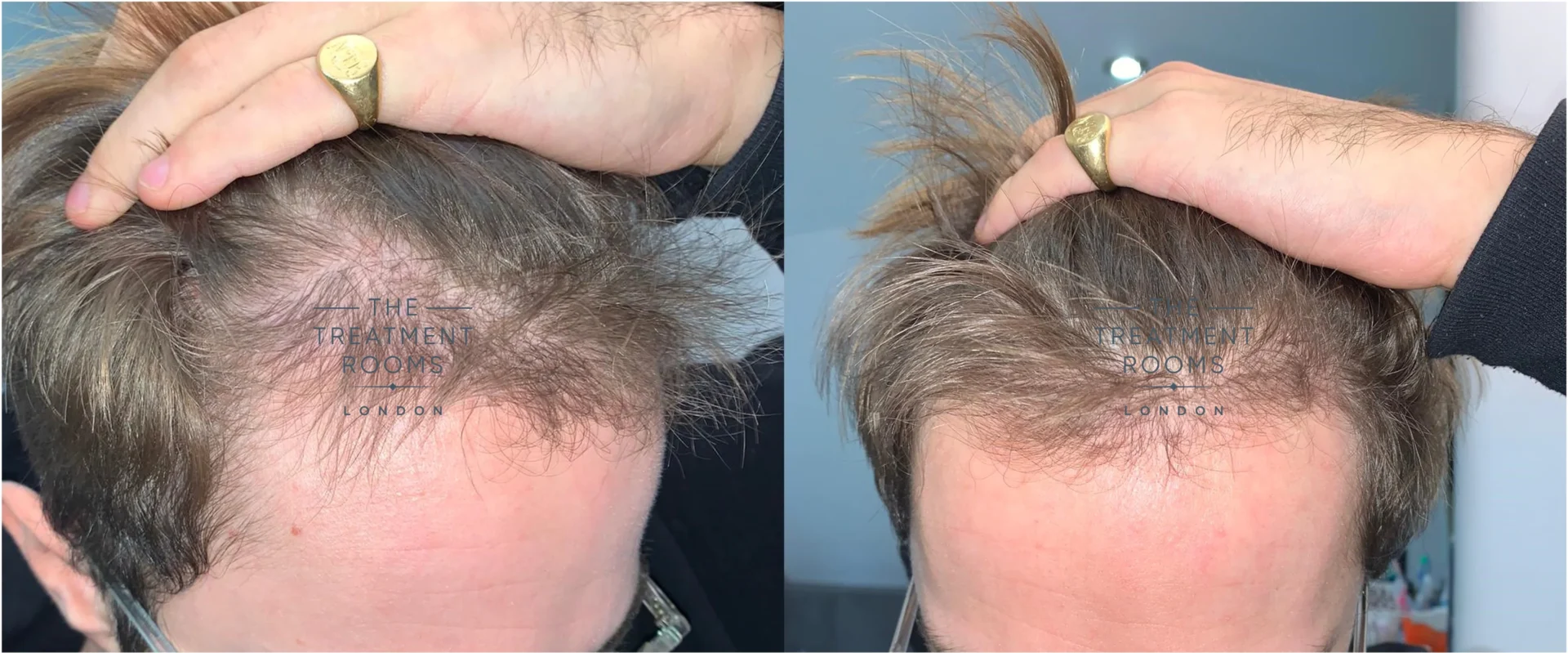 Unshaven hair transplant month 6 after surgery