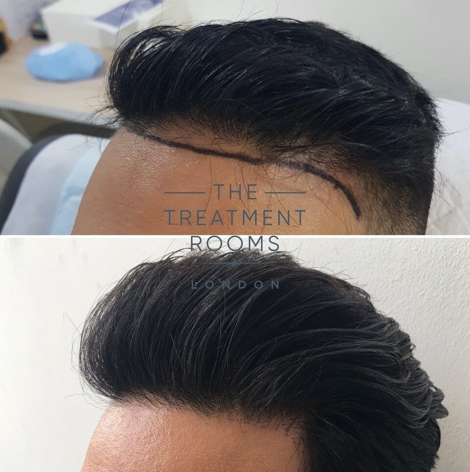 Left temporal hairline fue hair transplant results