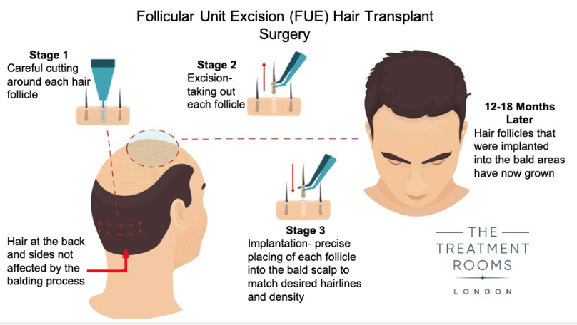 What Is A Hair Transplant? | Treatment Rooms London