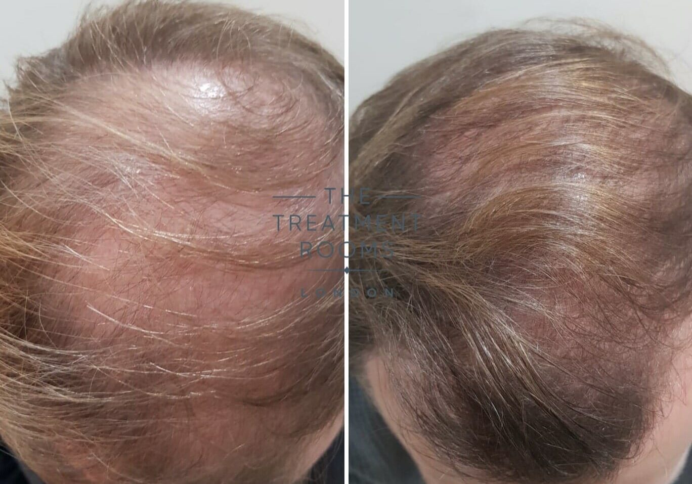 Crown hair transplant result london