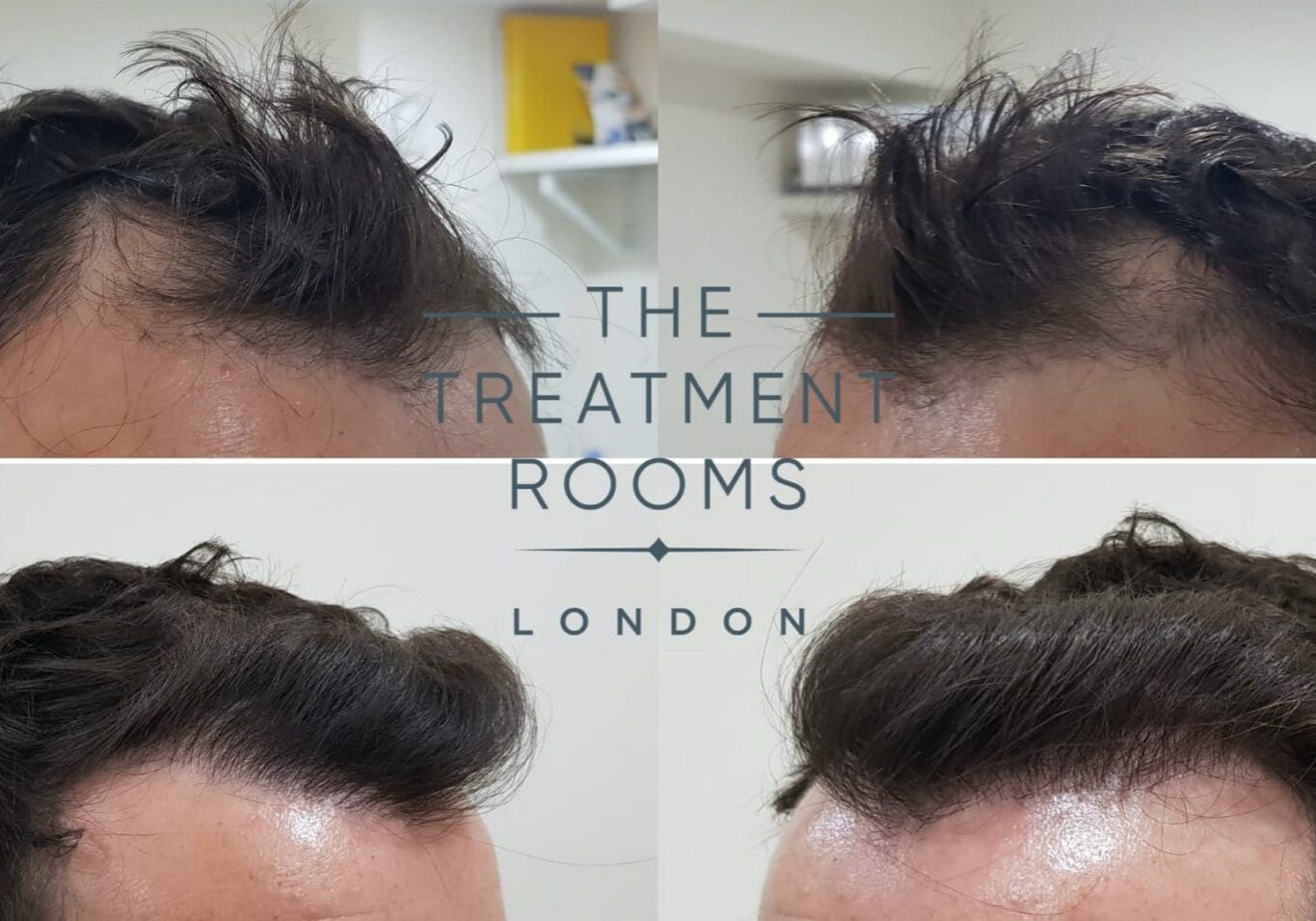 Left and Right hairline fue hair transplant