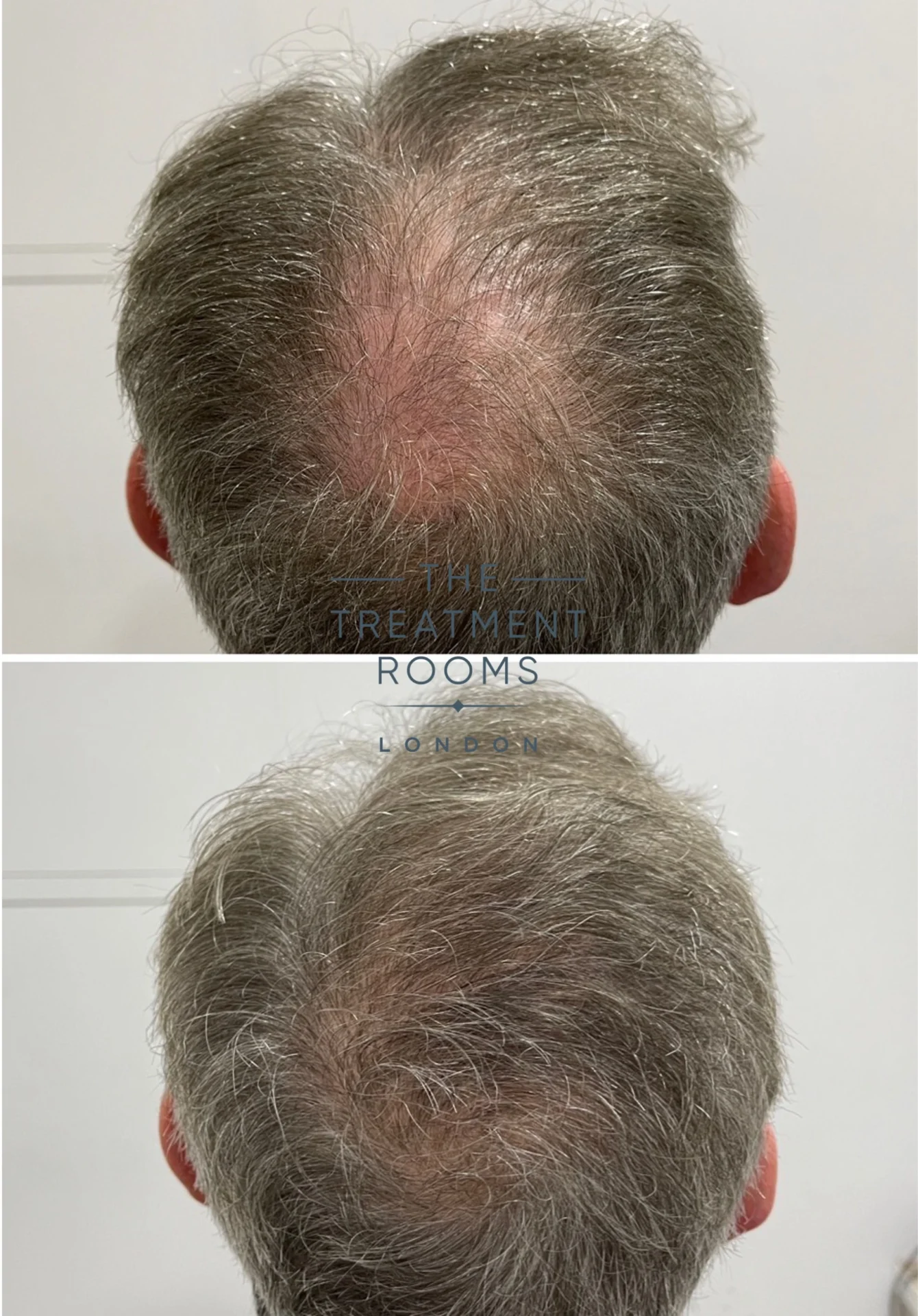 before and after crown fue hair transplant 681 grafts