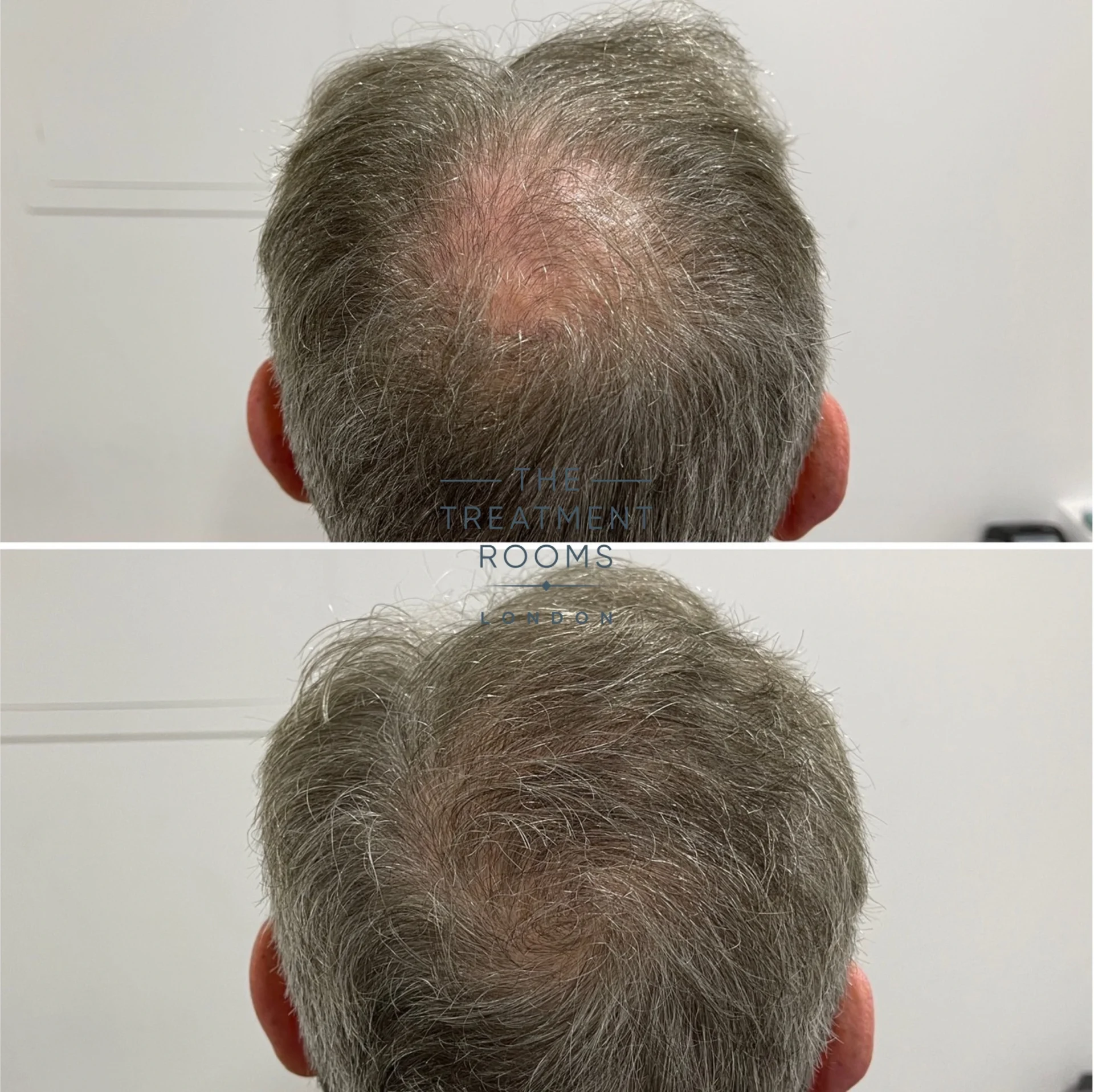 before and after crown hair transplant 681 grafts