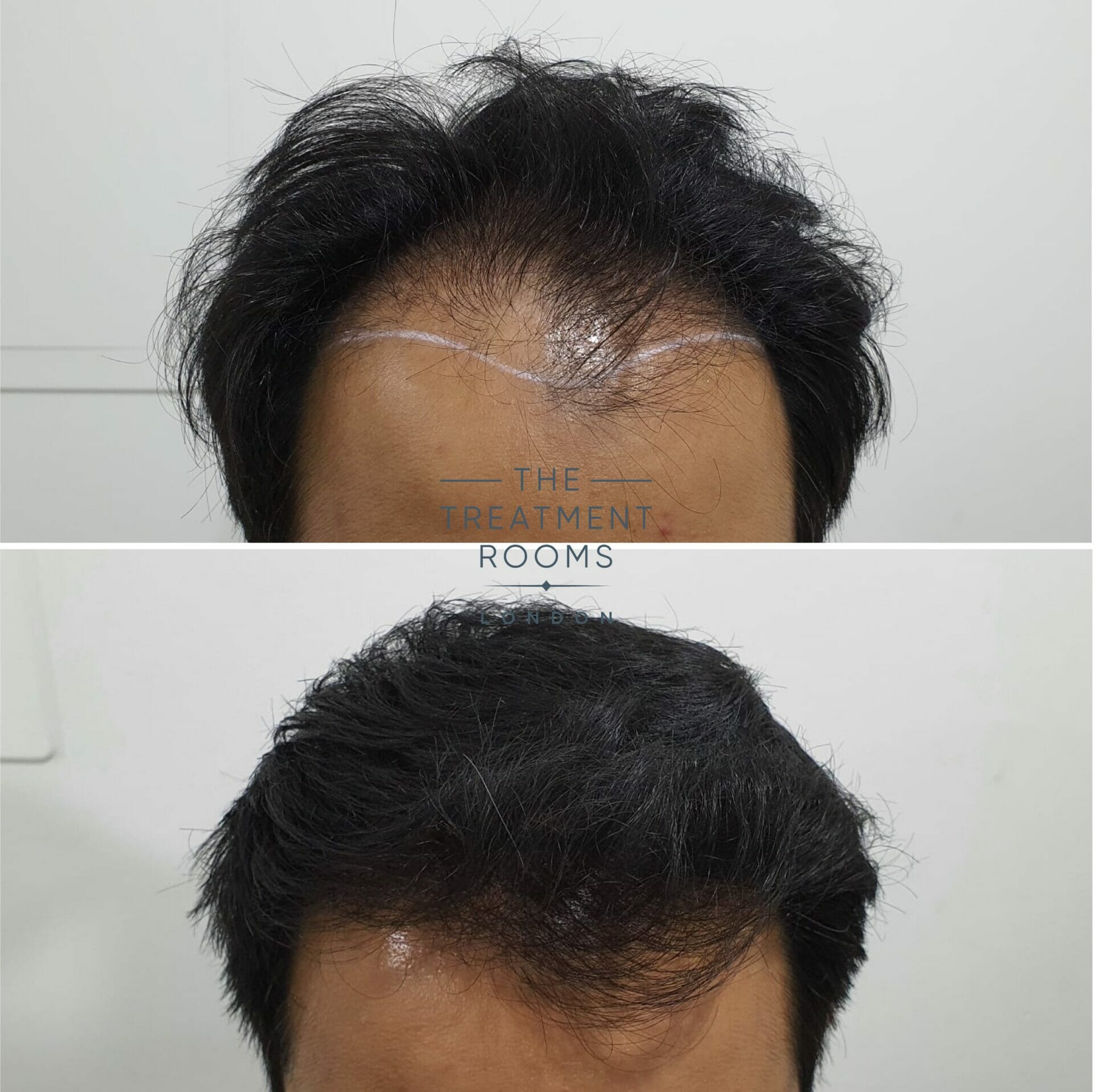 before and after fue hair transplant 1818 grafts hairline