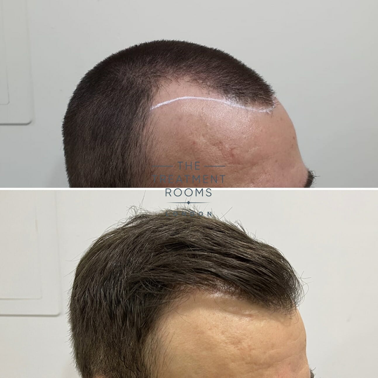 before and after hair transplant for receding hairline