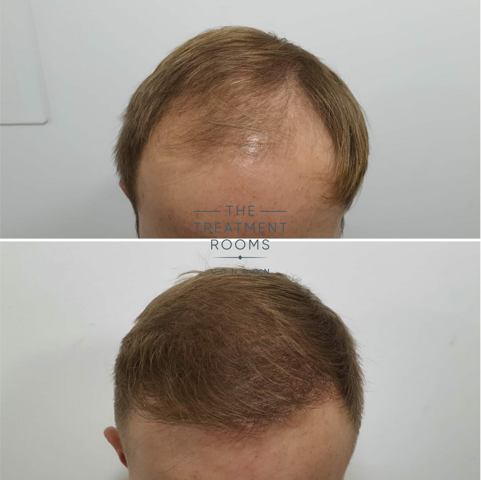 best UK hair transplant before and after 2190 grafts