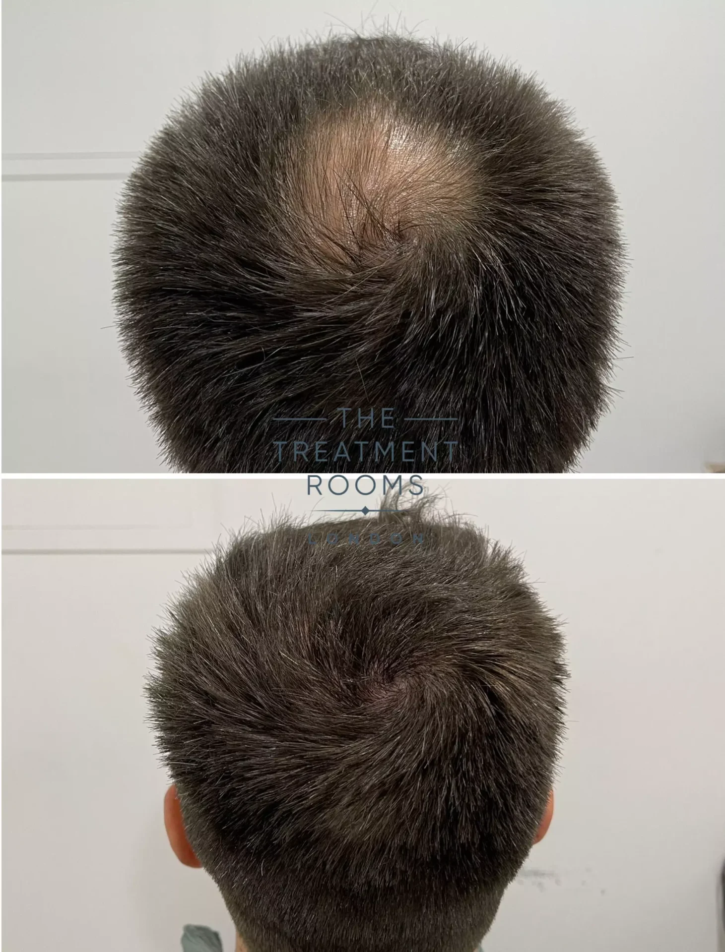 best crown hair transplant clinic UK 1930 grafts before and after