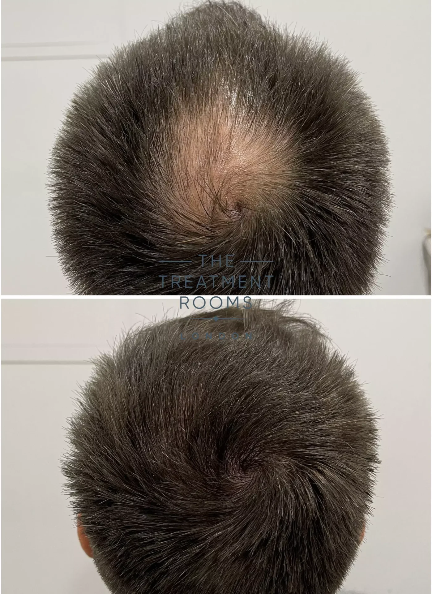 best crown hair transplant clinic london 1930 grafts before and after