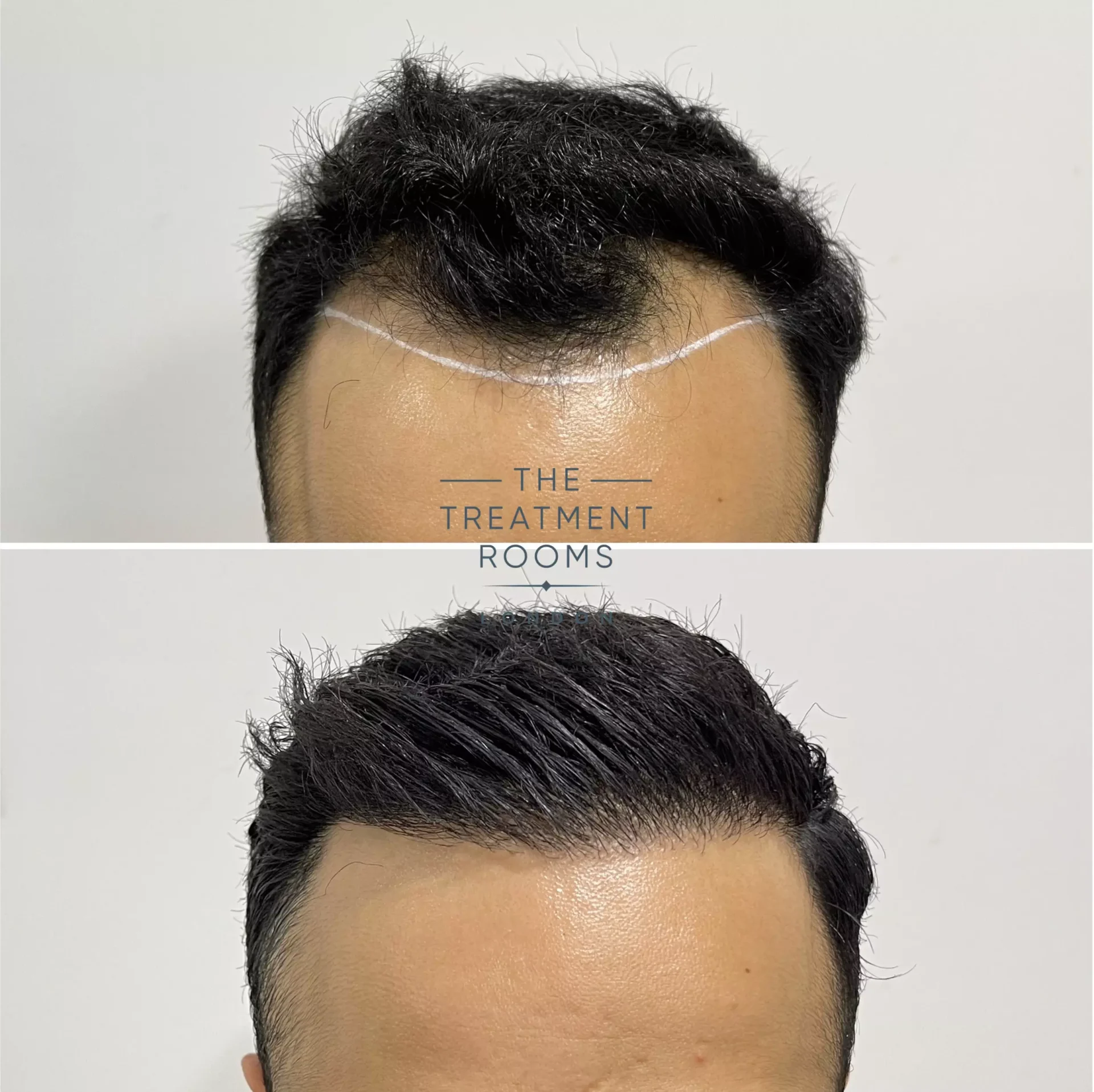 best fue clinic london 1274 grafts before and after