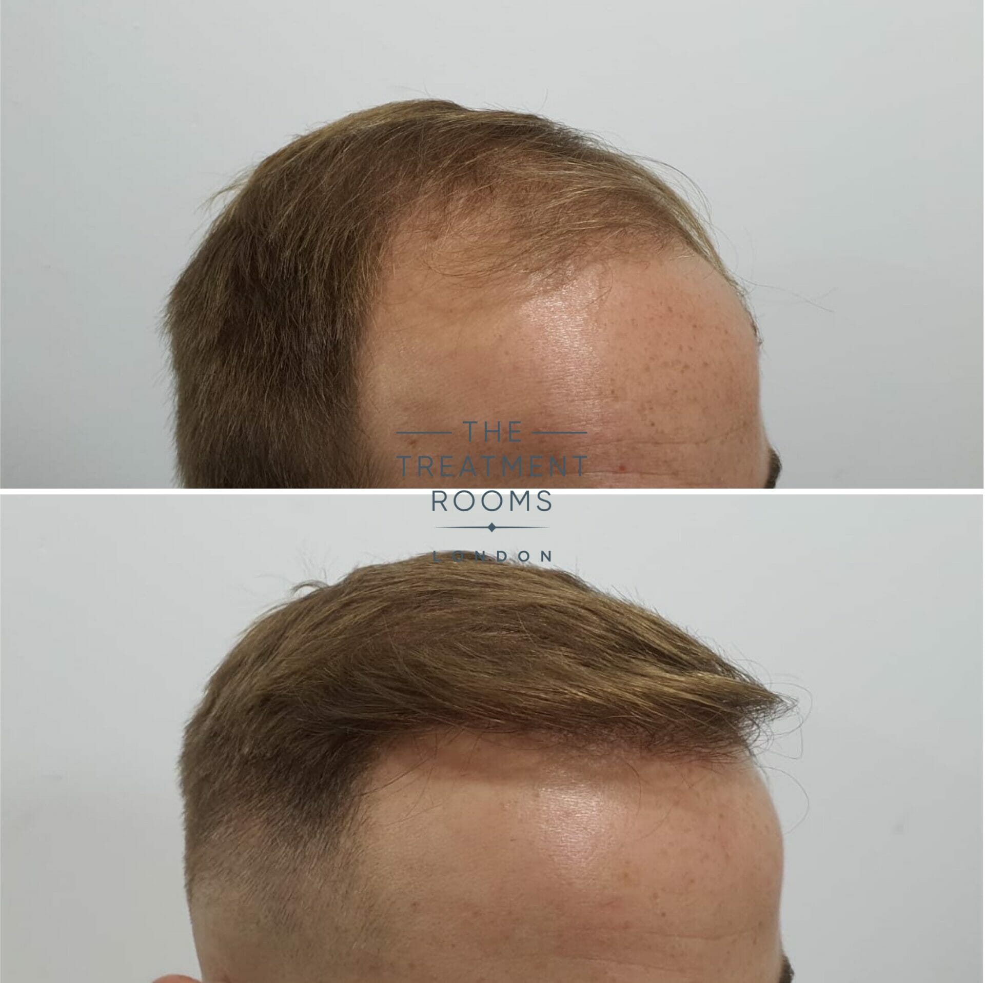 best fue hair transplant clinic in london before and after 2190 grafts