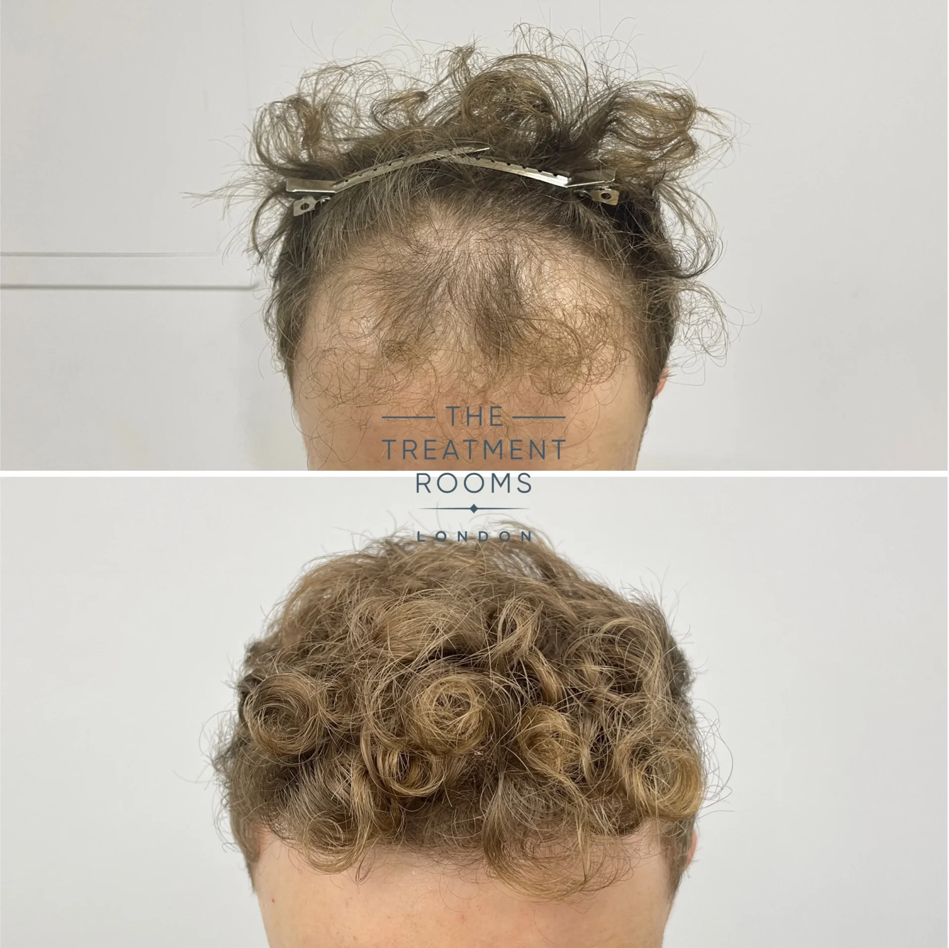 best fue hair transplant clinic london 1514 grafts before and after