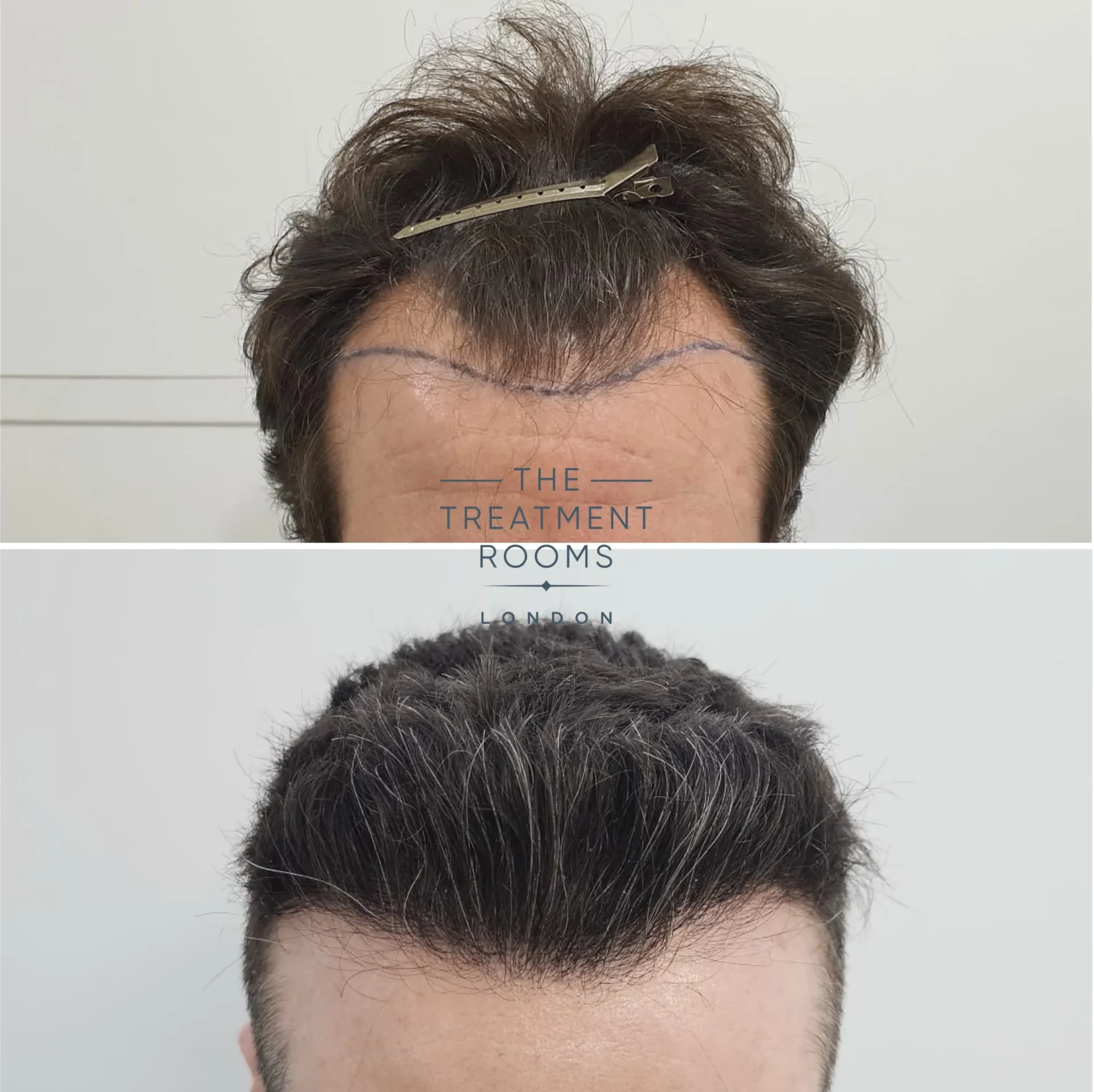 best fue hair transplant clinic london 1745 grafts before and after