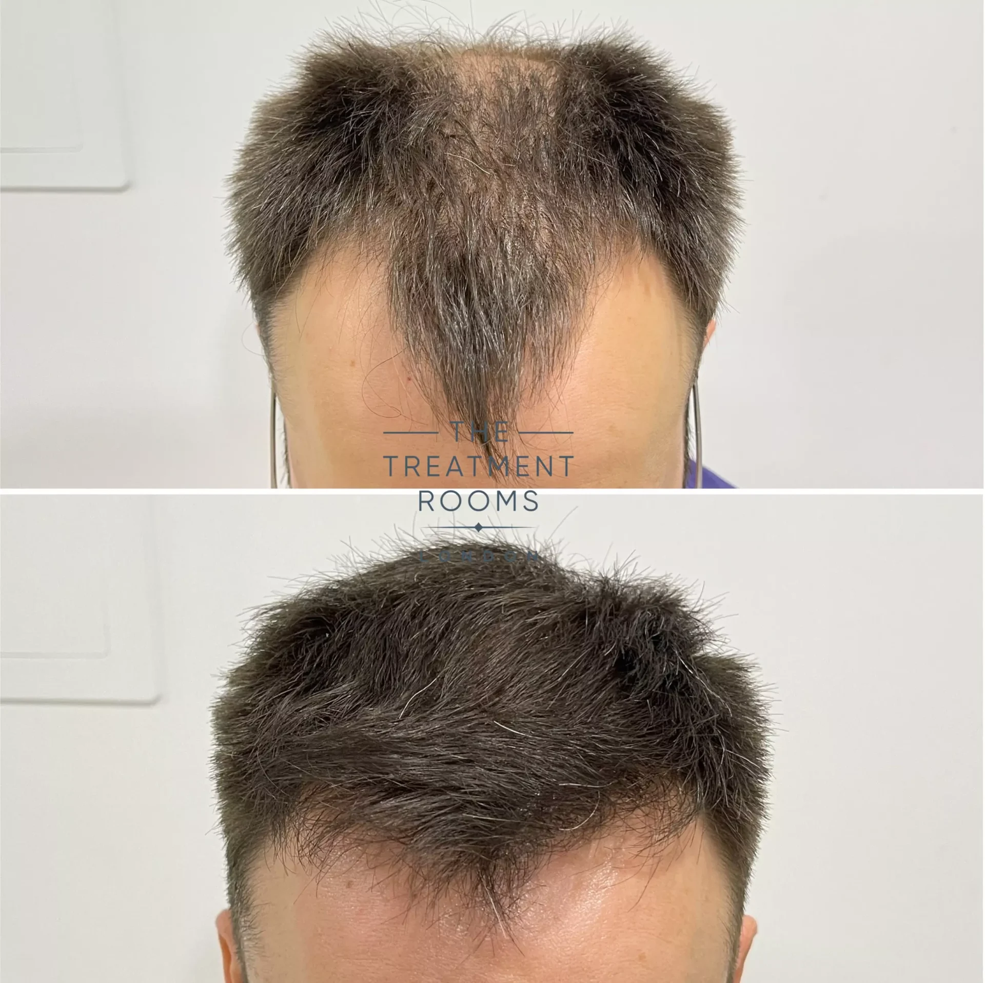 best fue hair transplant clinic london 1930 grafts before and after