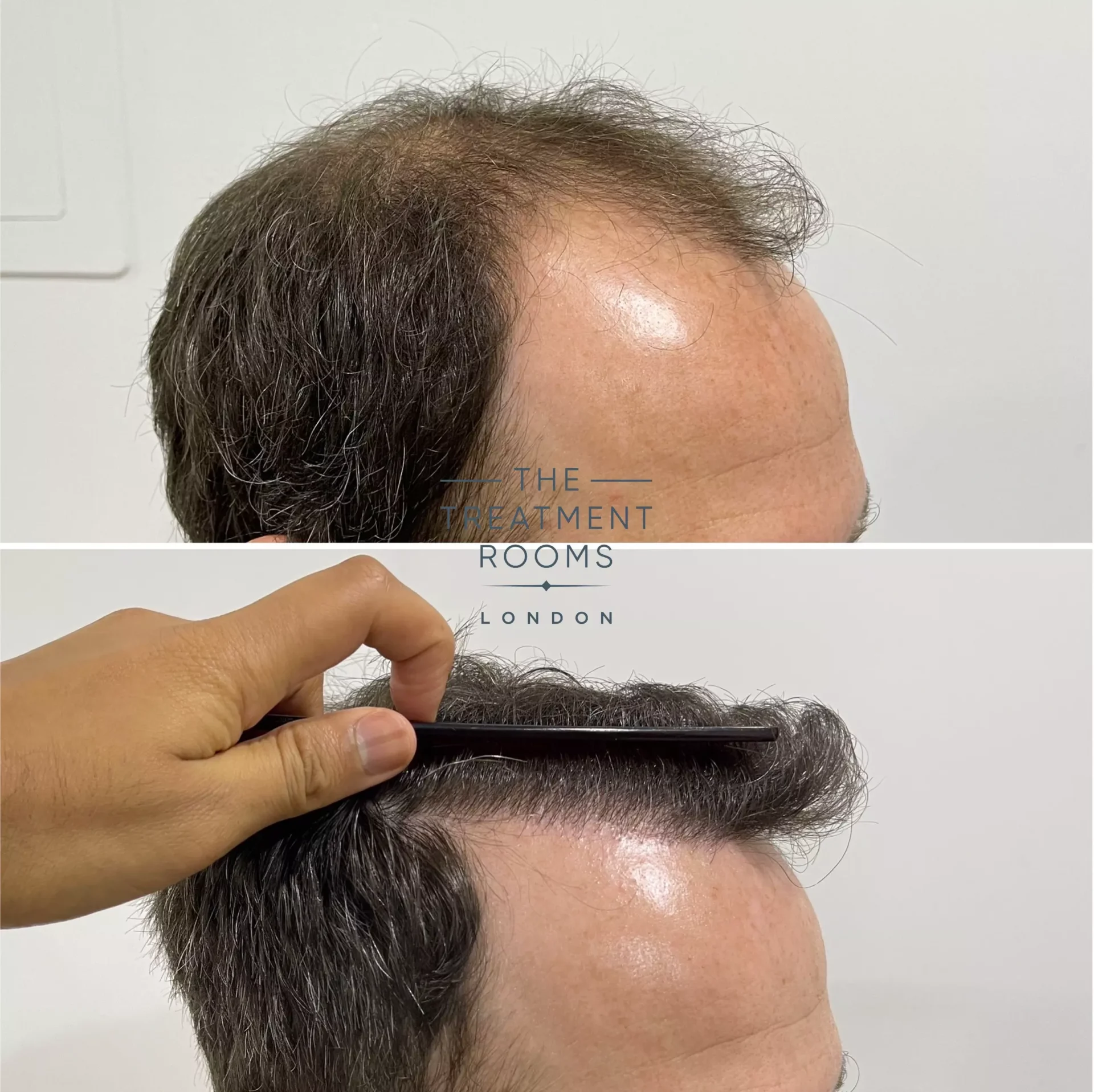best fue hair transplant clinic london 2076 grafts