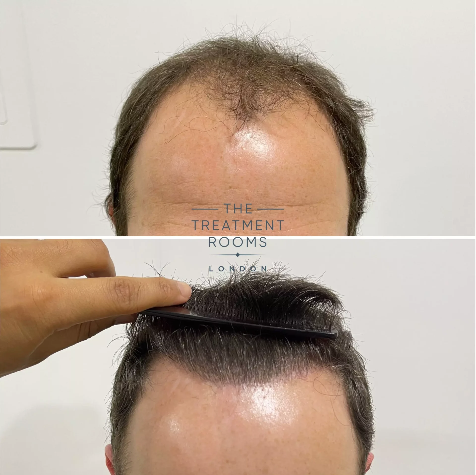 best fue hair transplant london 2076 grafts before and after