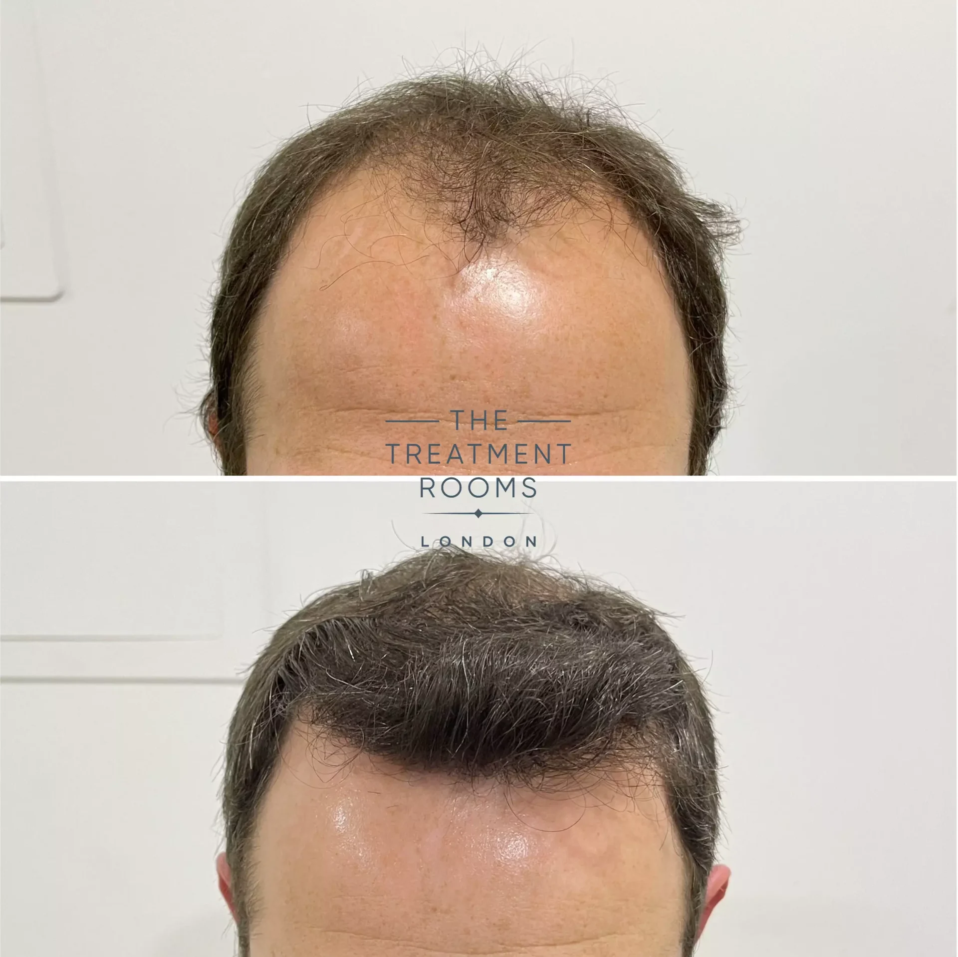 best fue hair transplant london 2076 grafts