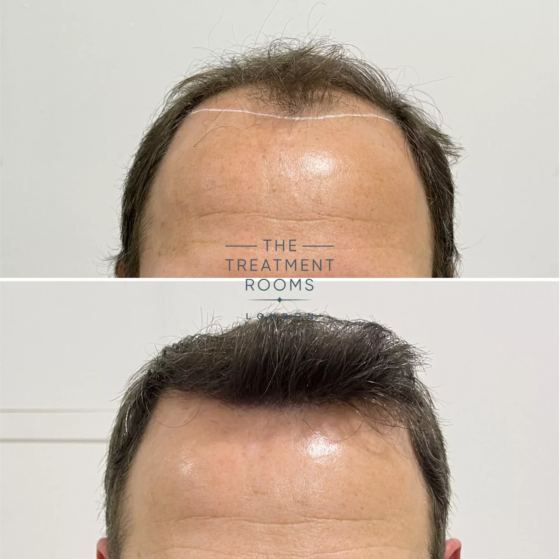 best hair transplant 2076 grafts before and after