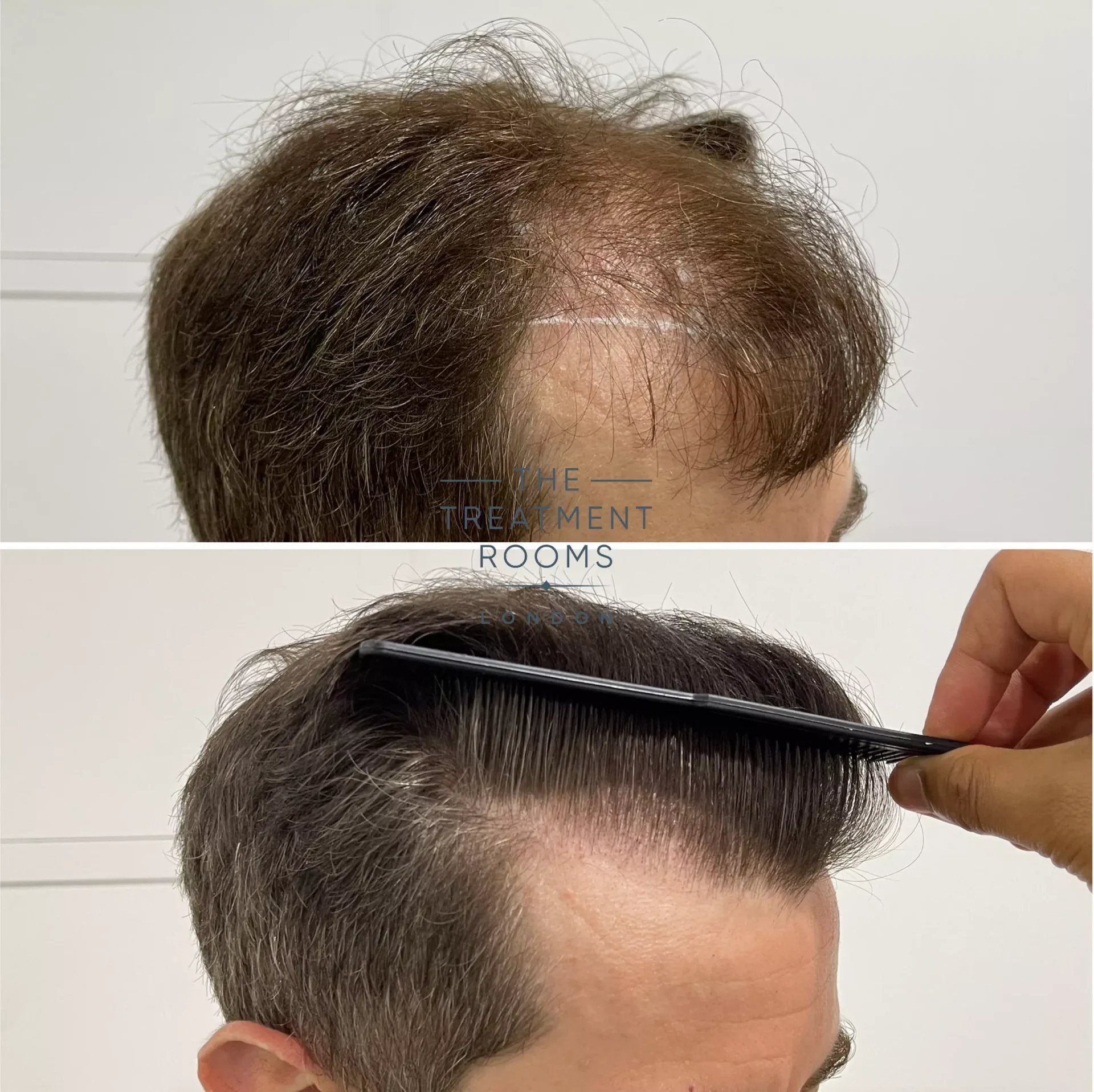 best hair transplant UK before and after 1491 grafts