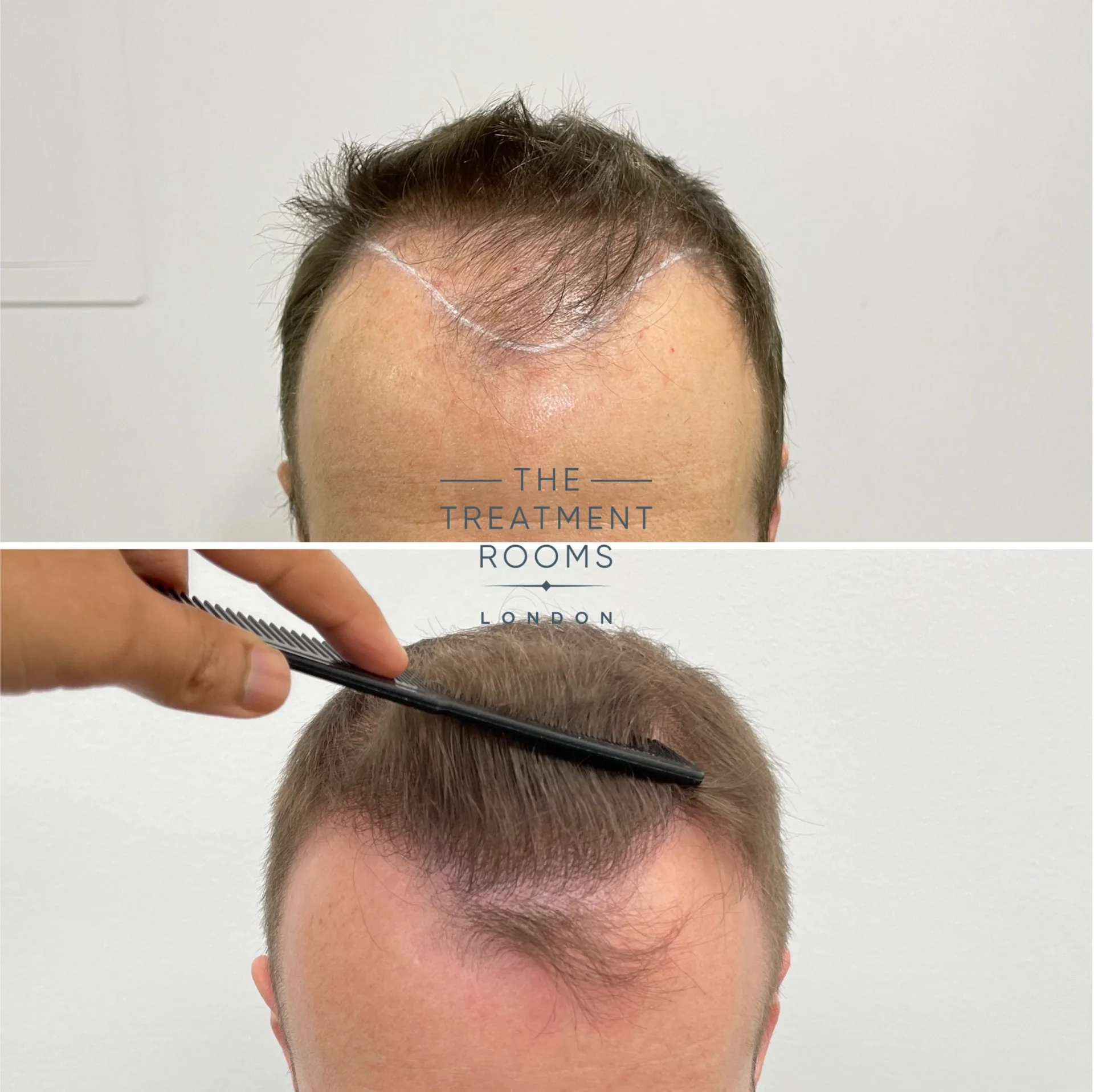 best hair transplant before and after 1592 grafts