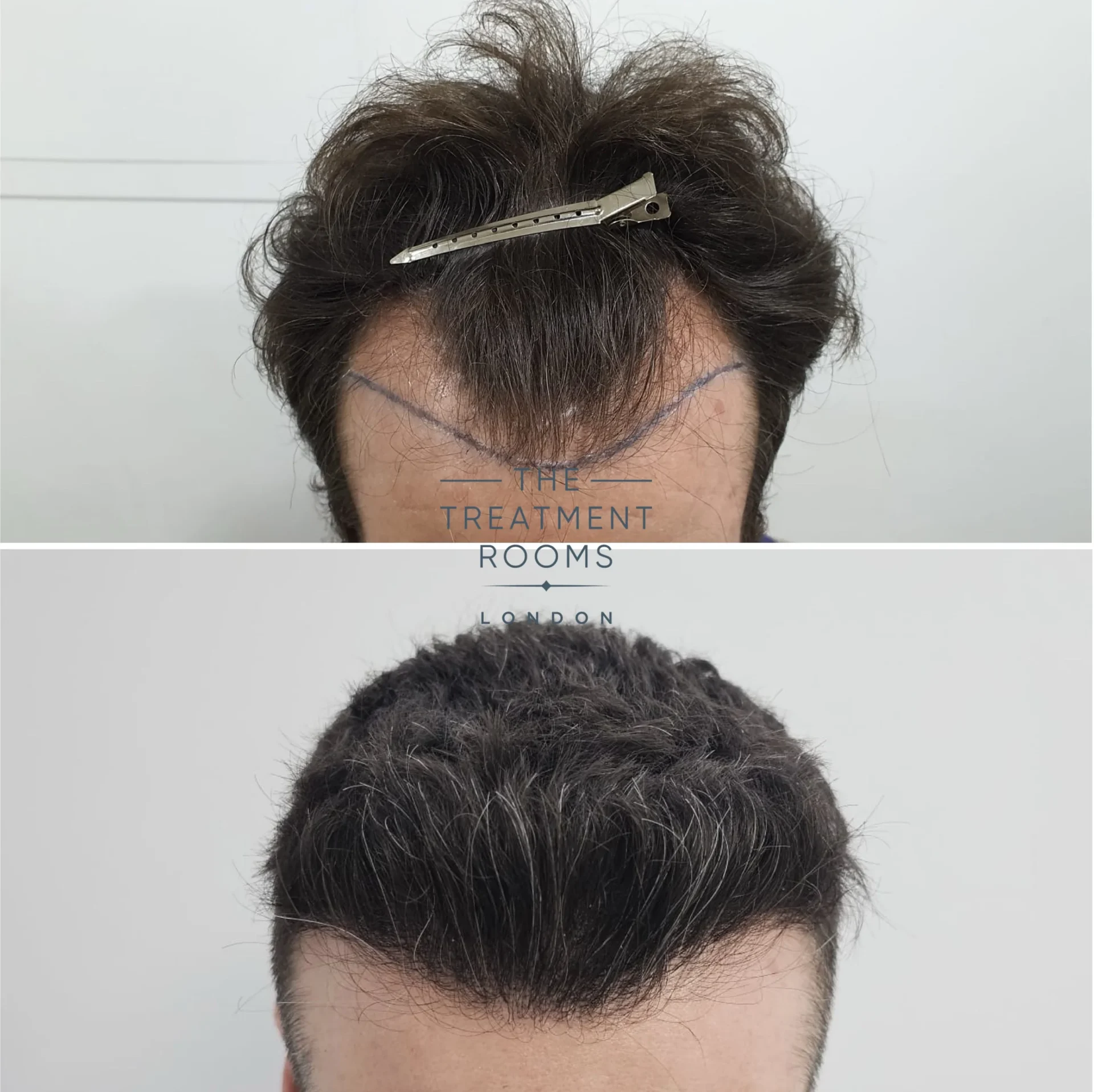 best hair transplant clinic 1745 grafts before and after