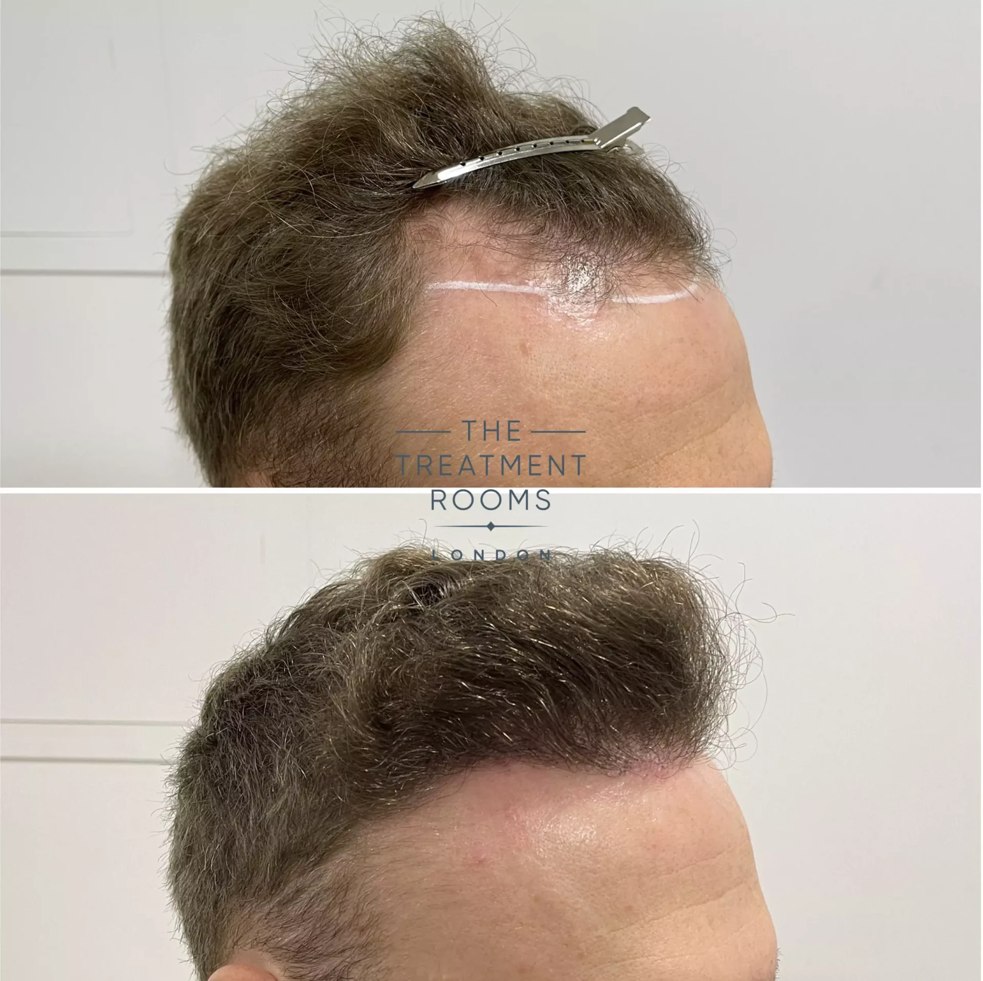 best hair transplant clinic UK 1346 grafts before and after
