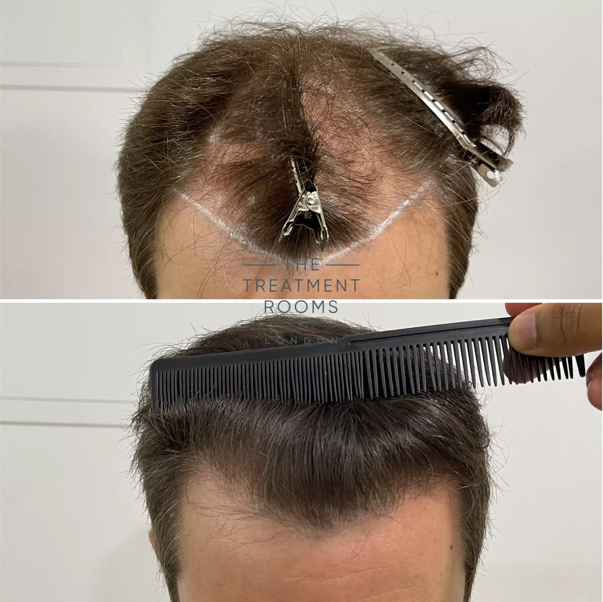 best hair transplant clinic UK before and after 1491 grafts