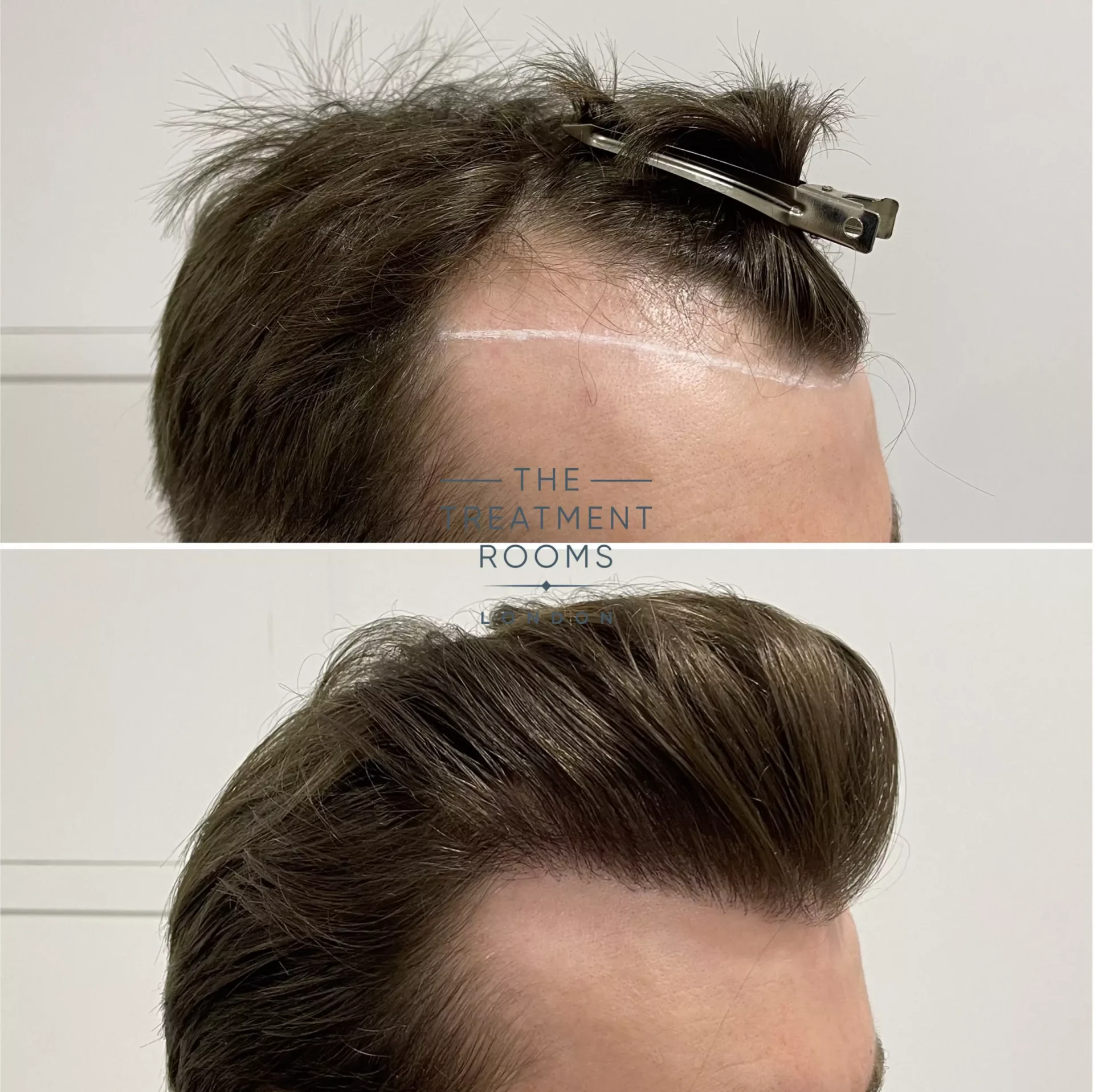 best hair transplant clinic before and after 1357 grafts