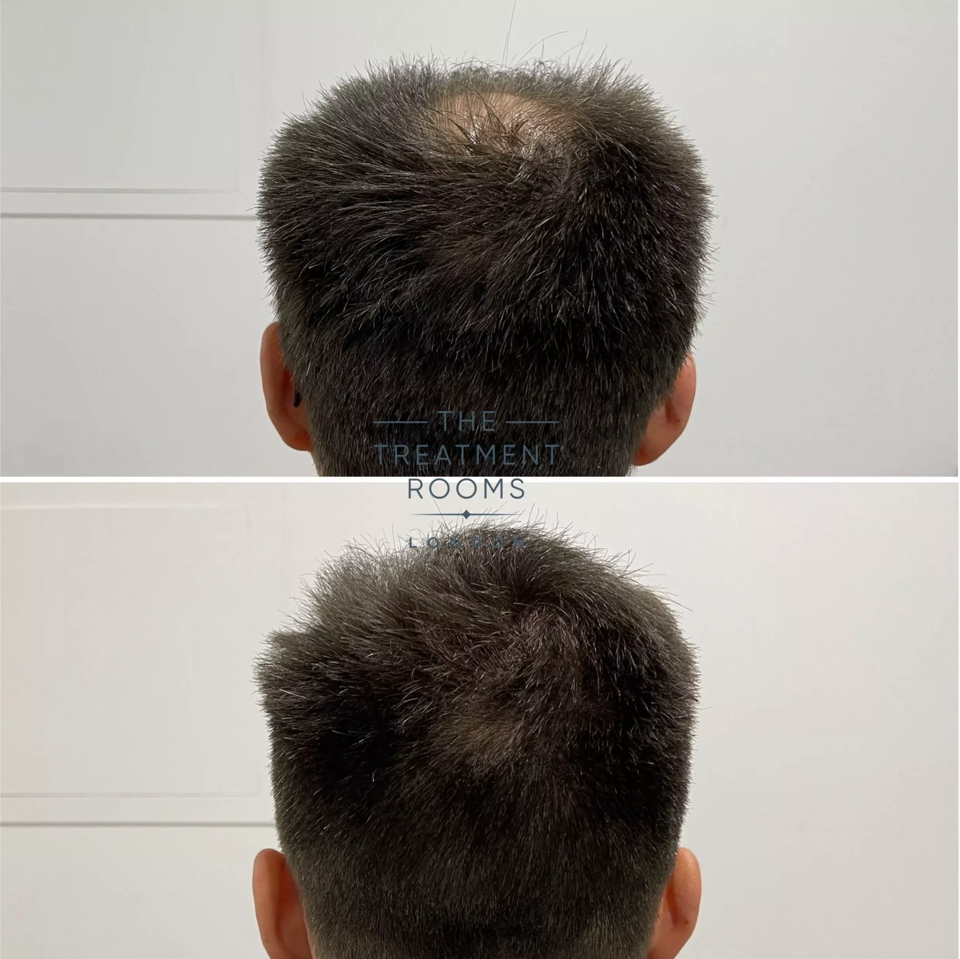 best hair transplant clinic for crown 1930 grafts before and after