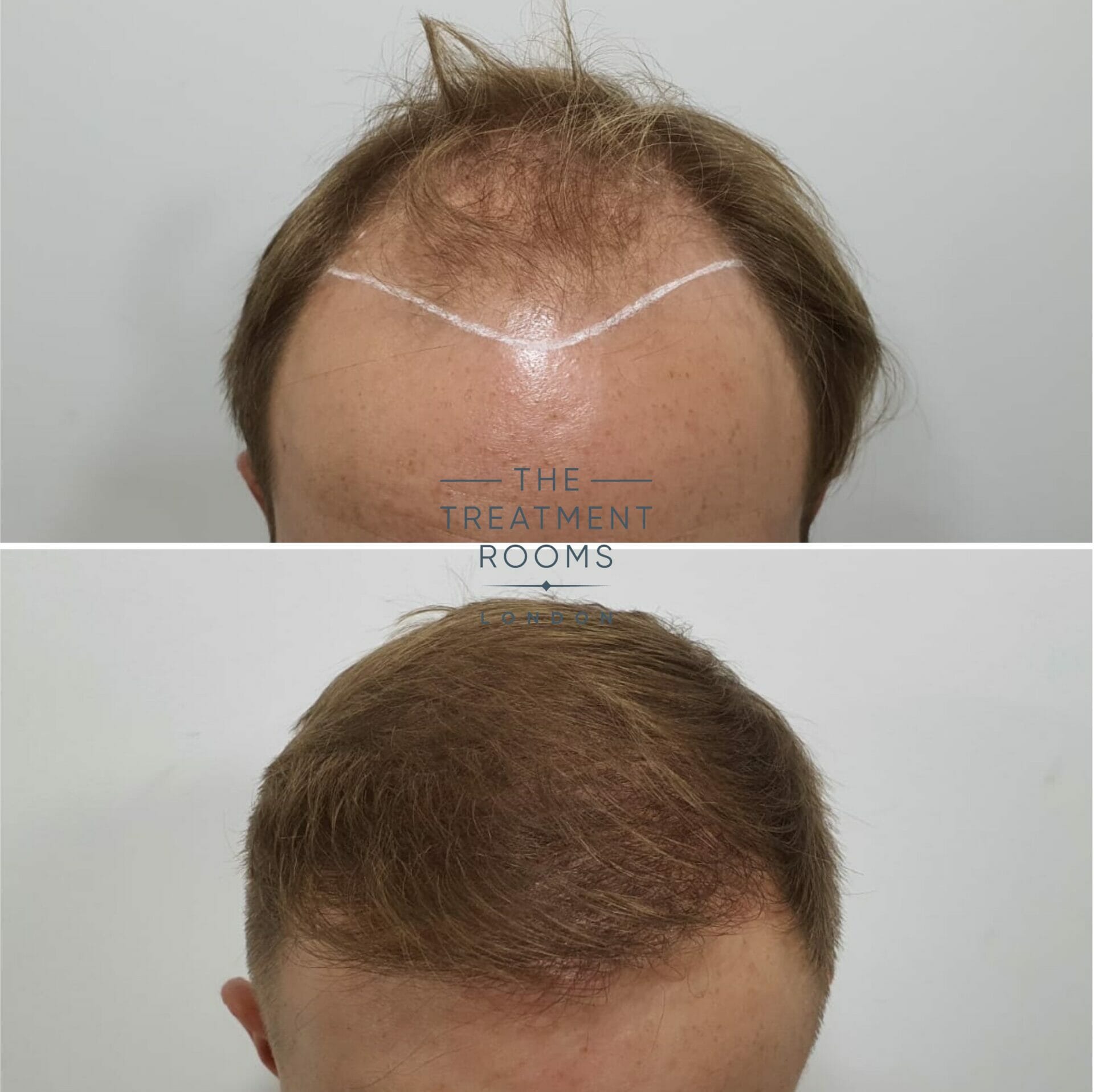 best hair transplant clinic in london before and after 2190 grafts