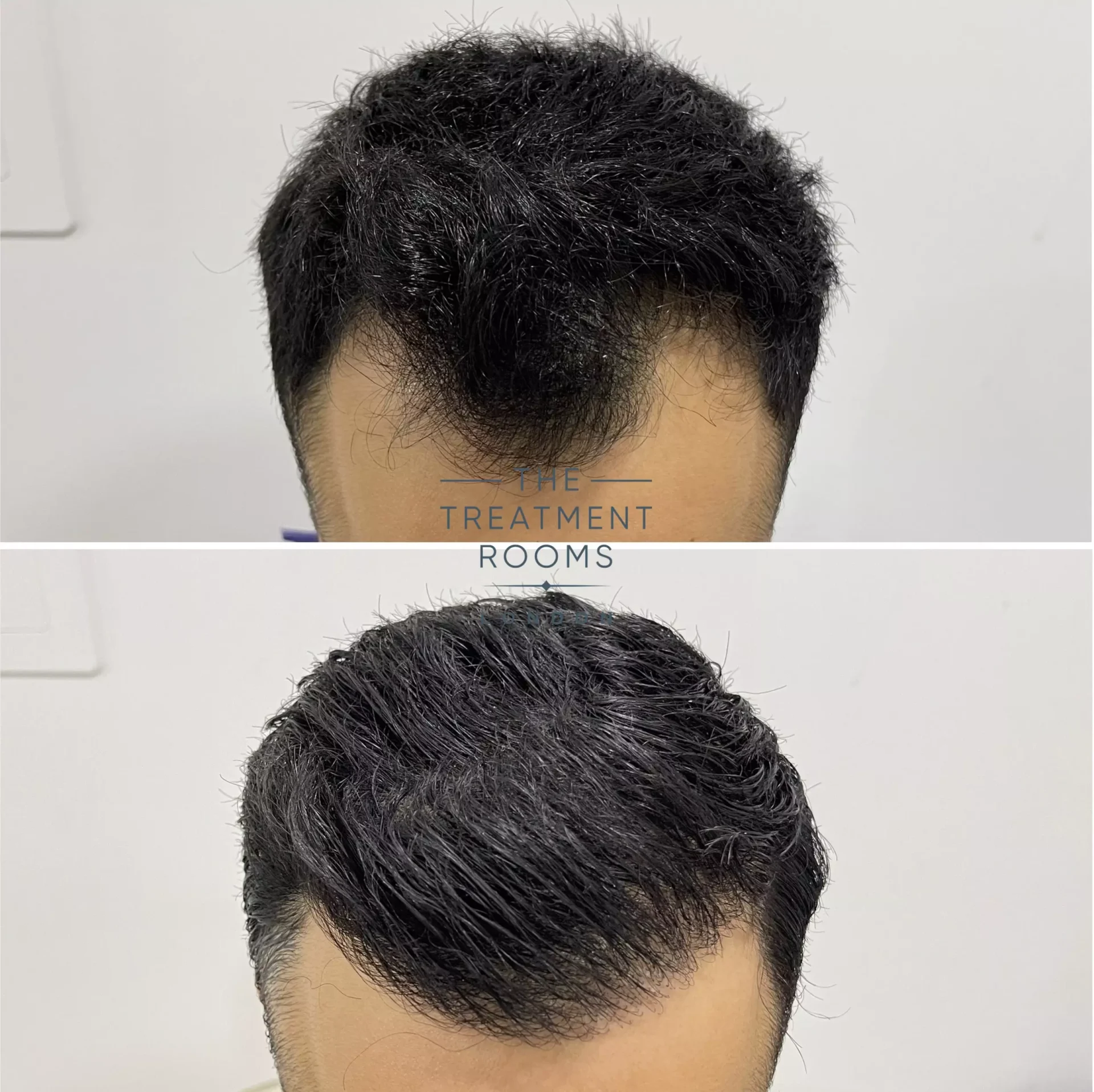 best hair transplant clinic london 1274 grafts before and after