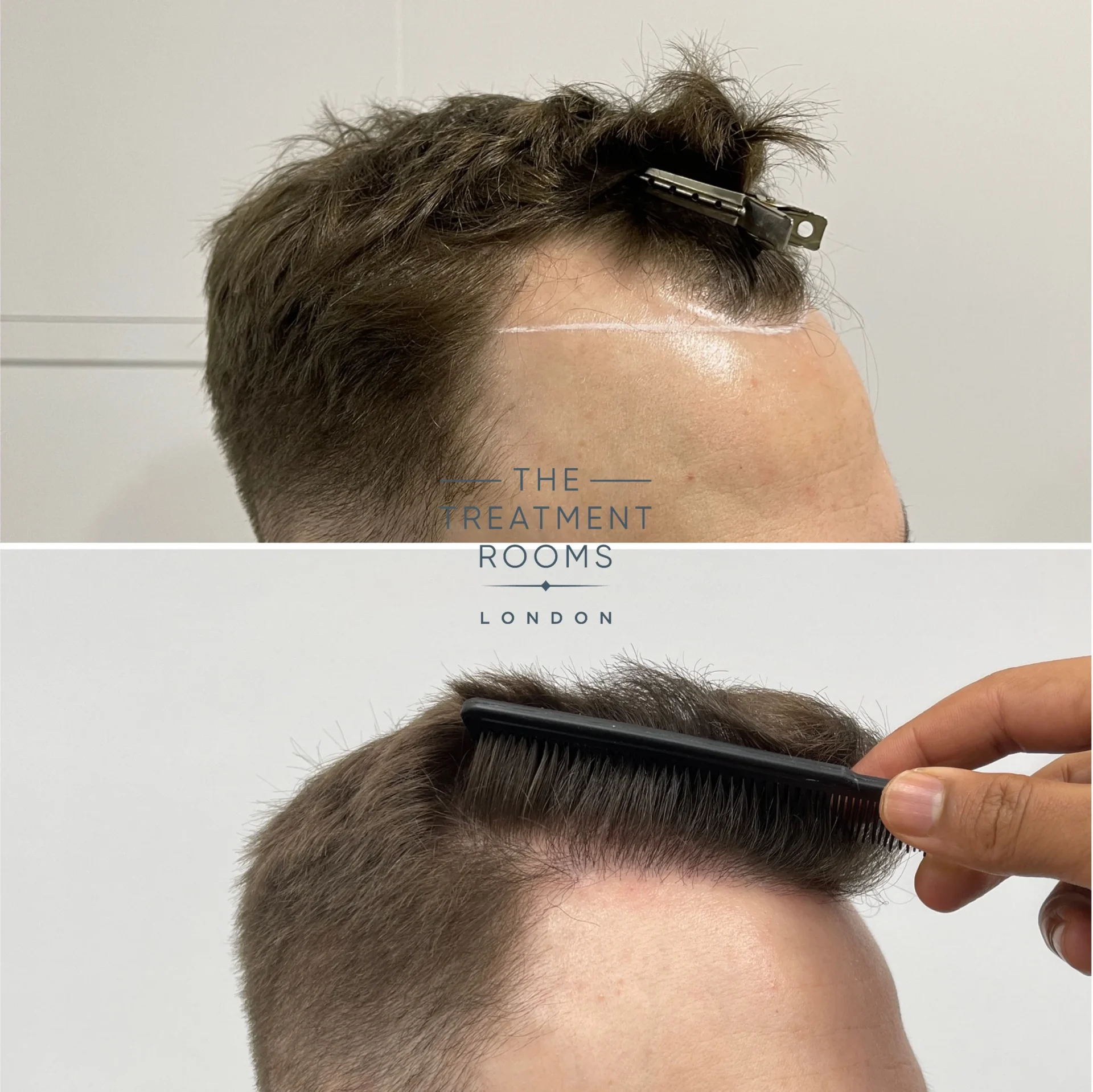 best hair transplant clinic london 1314 grafts before and after