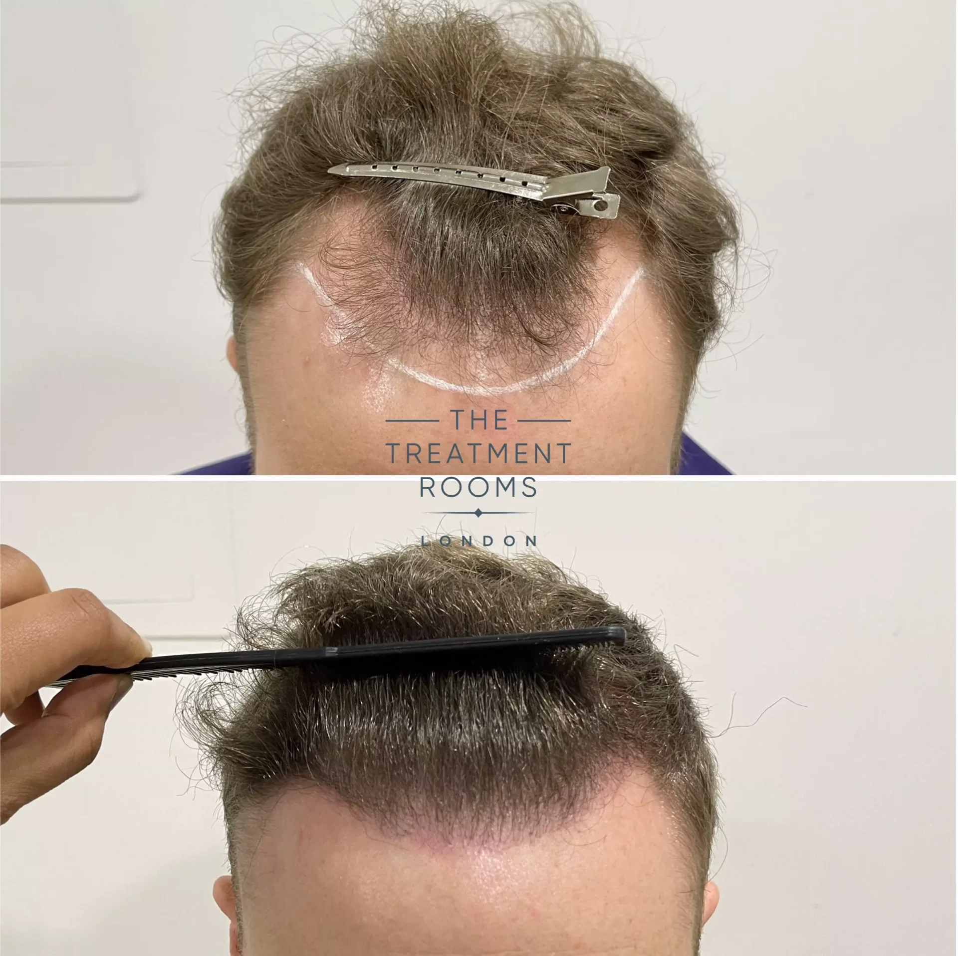 best hair transplant clinic london 1346 grafts before and after