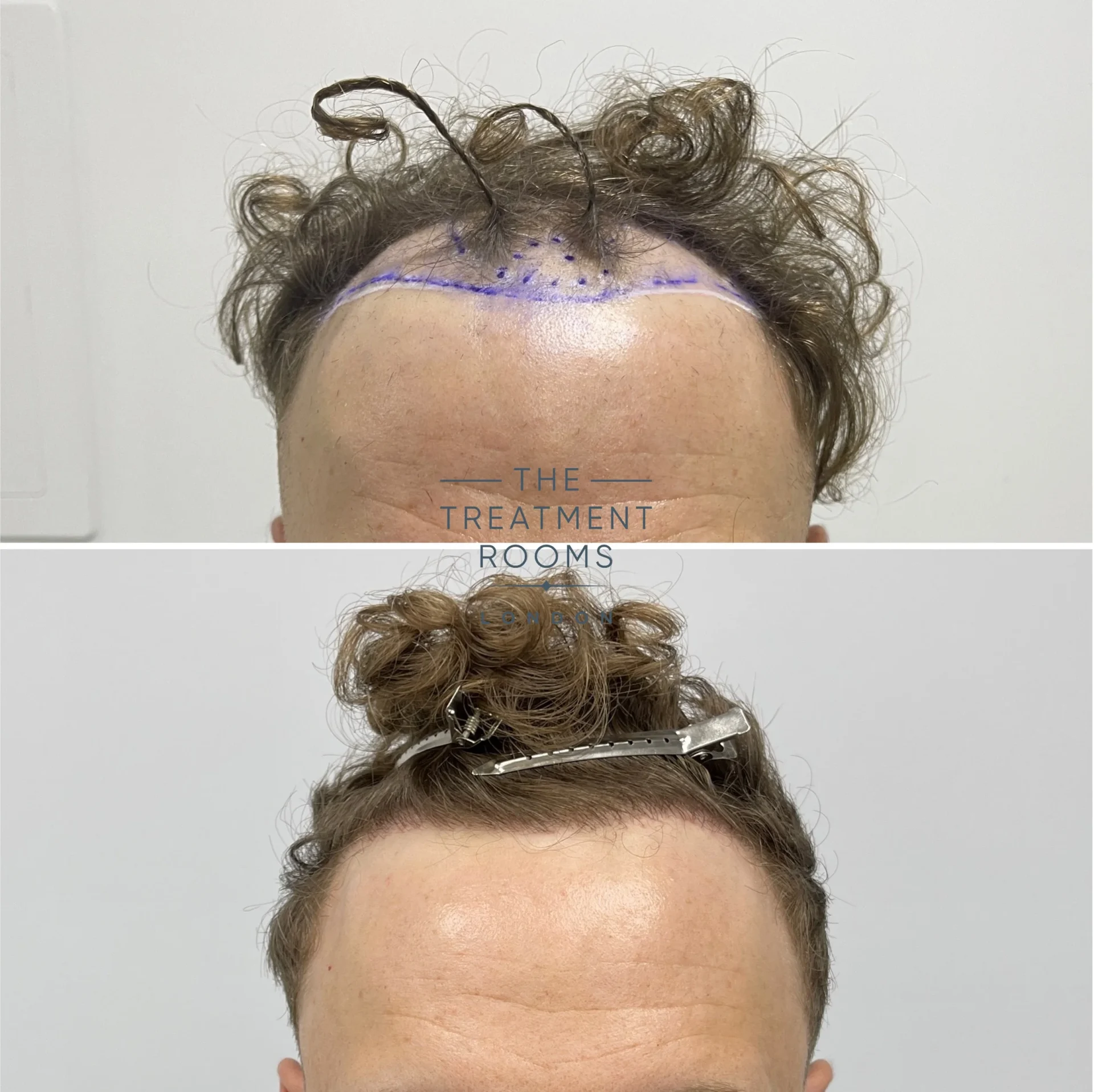 best hair transplant clinic london 1514 grafts before and after
