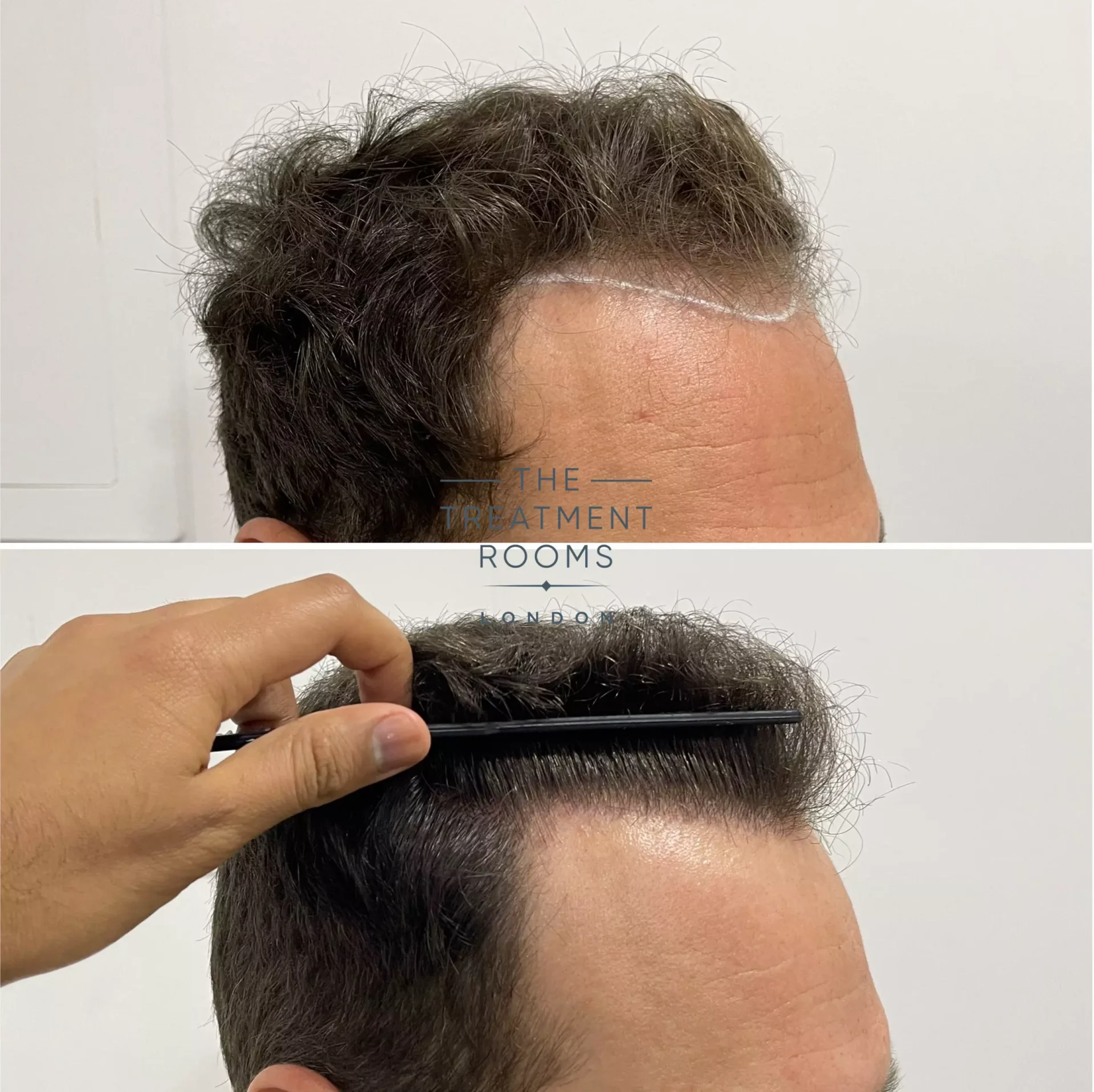 best hair transplant clinic london 1736 grafts before and after