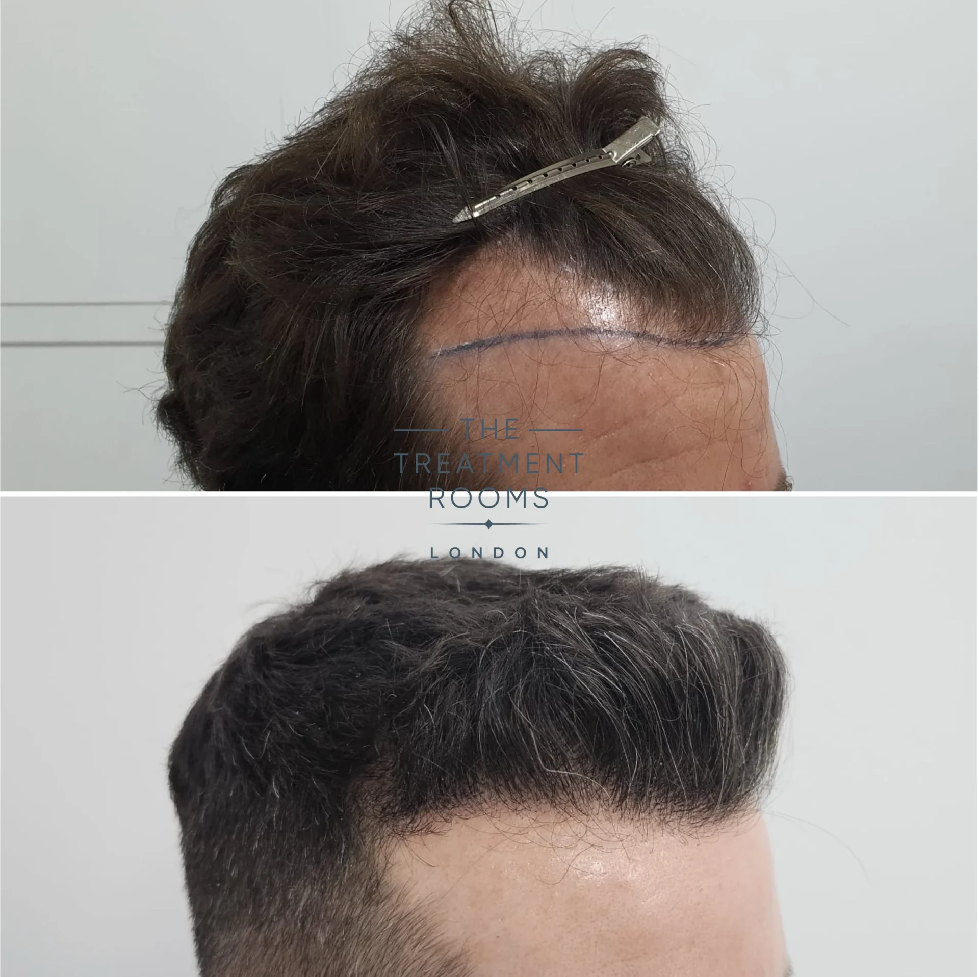 best hair transplant clinic london 1745 grafts before and after