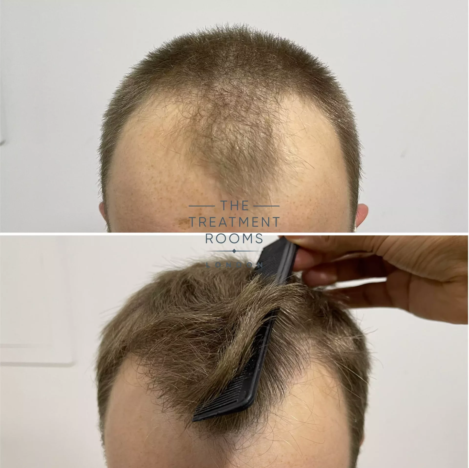 best hair transplant clinic london 1756 grafts before and after