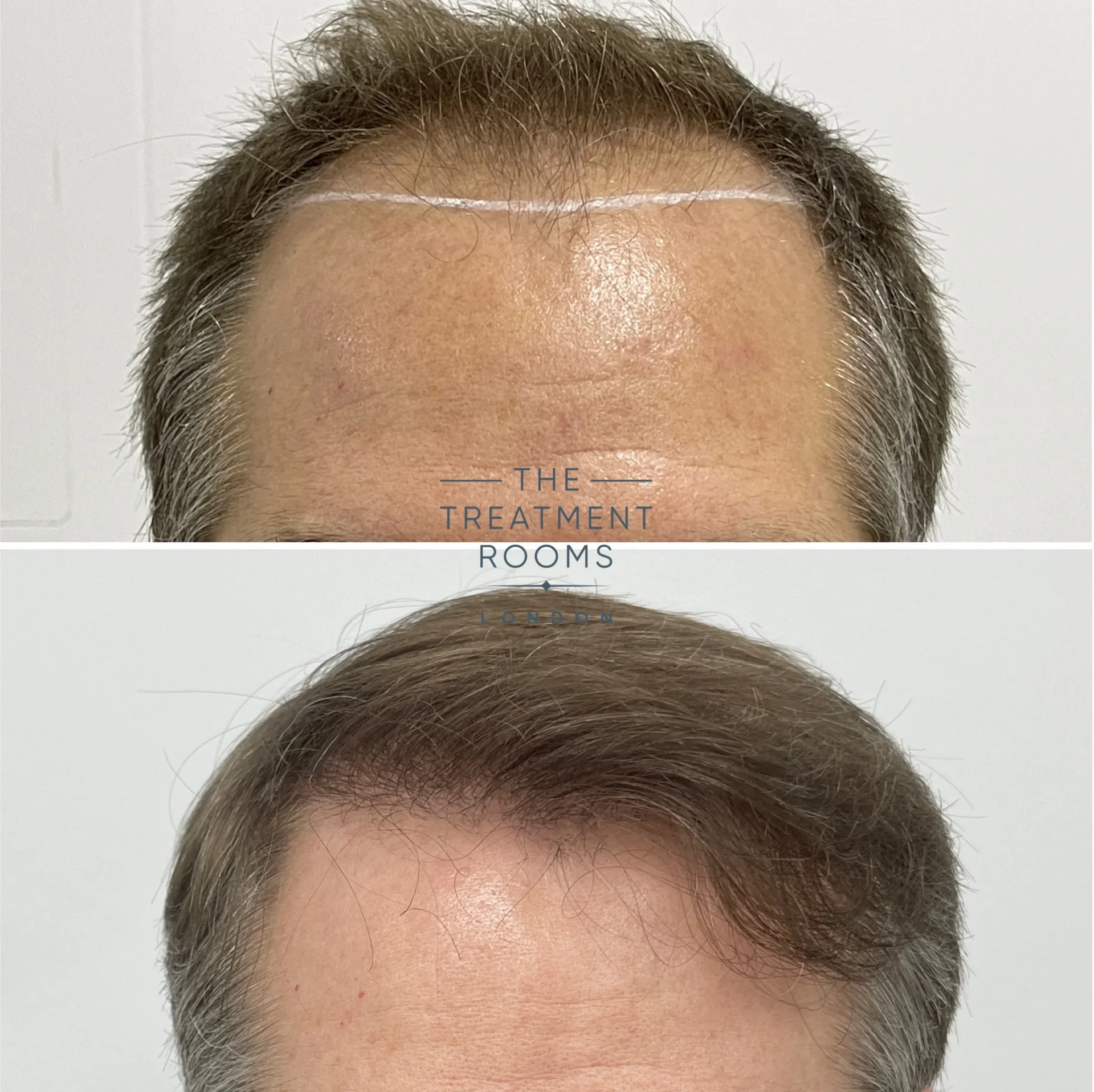 best hair transplant clinic london 1839 grafts before and after