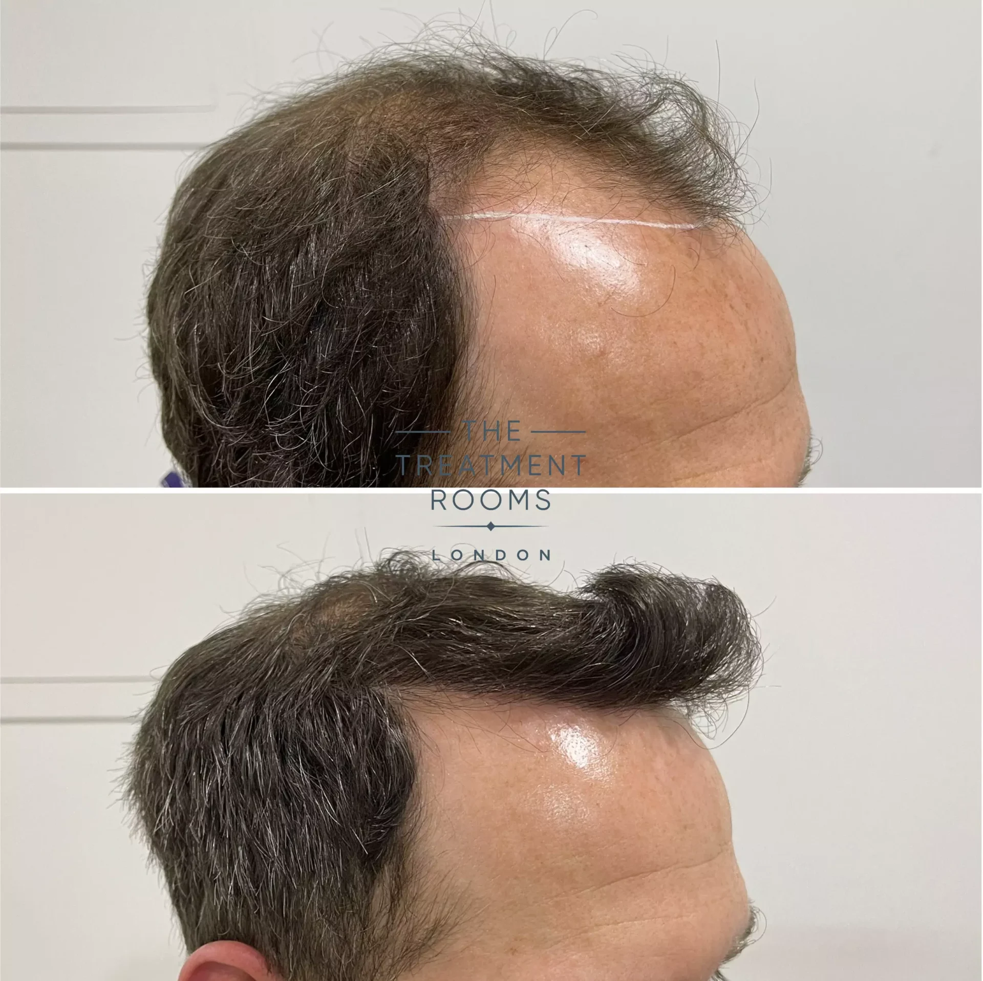 best hair transplant clinic london 2076 grafts