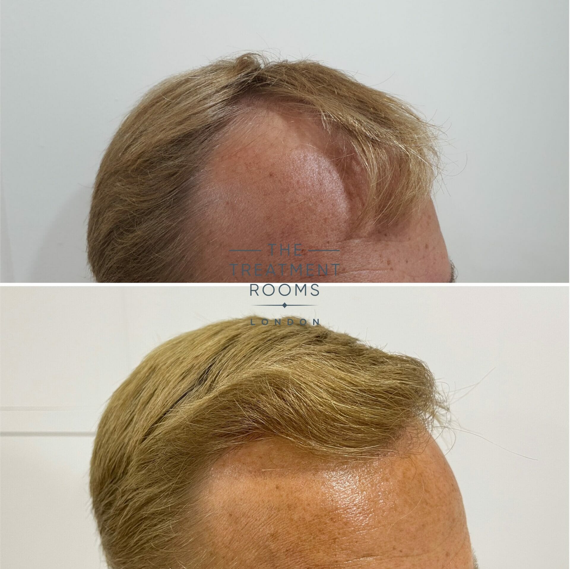 best hair transplant clinic london before and after hairline surgery