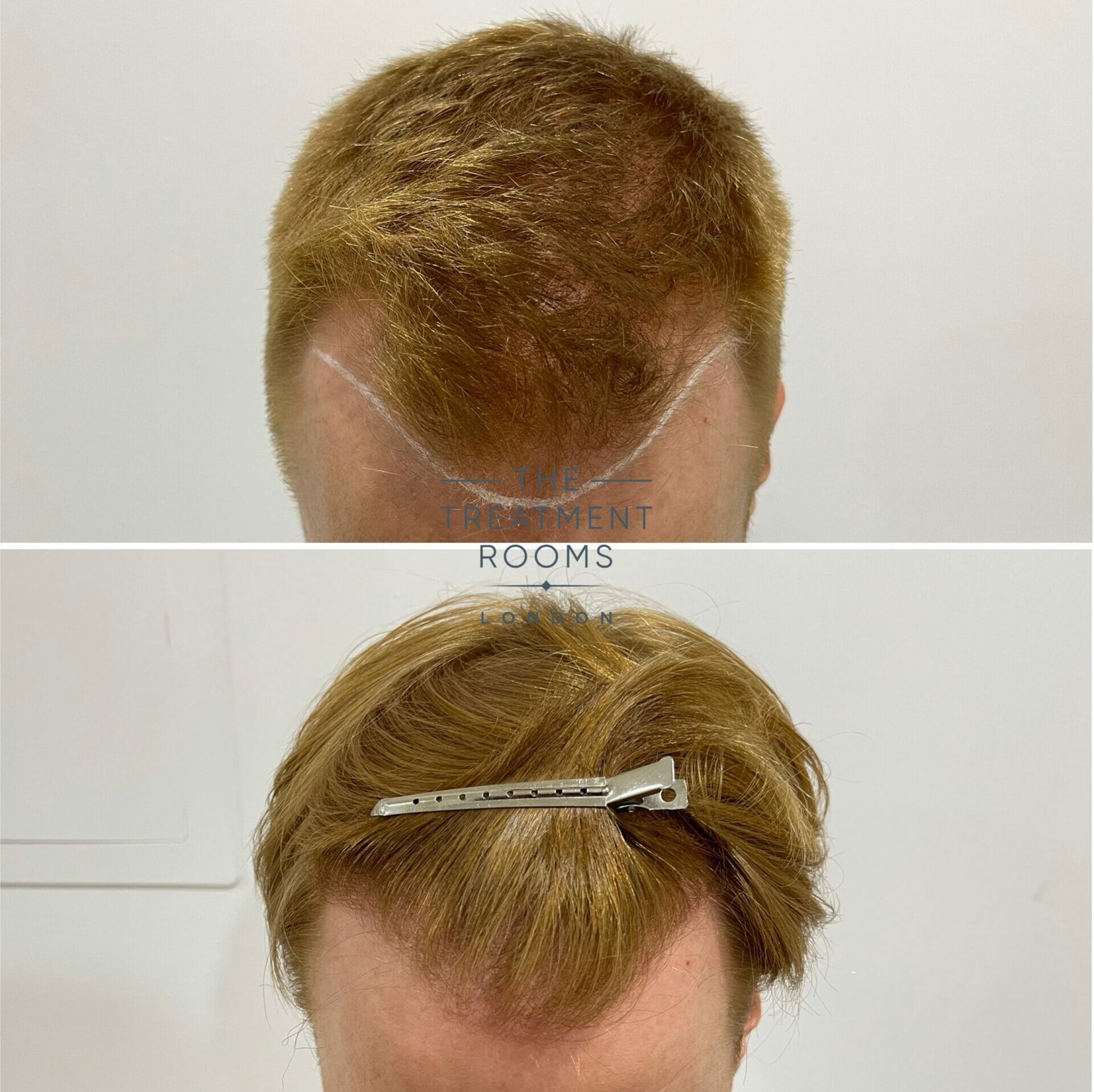 best hair transplant clinic london hairline before and after 1426 grafts