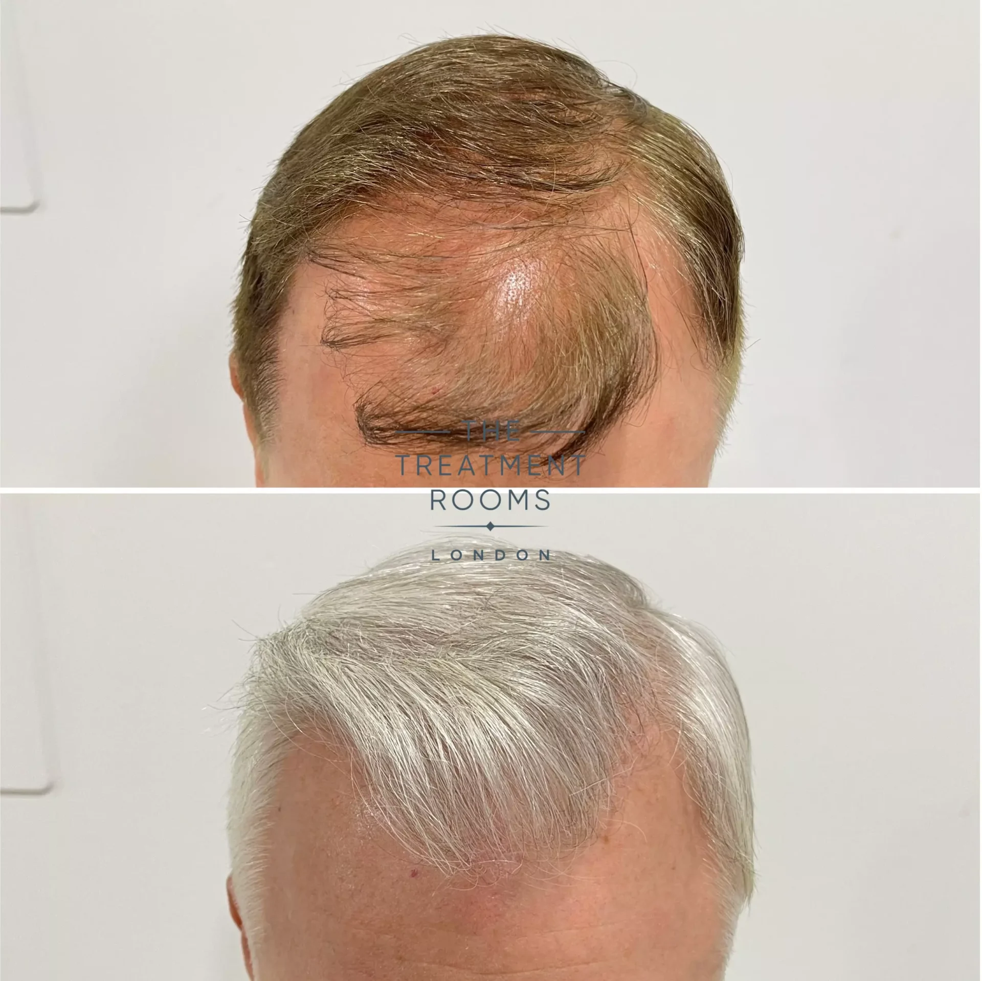 best hair transplant clinic london review