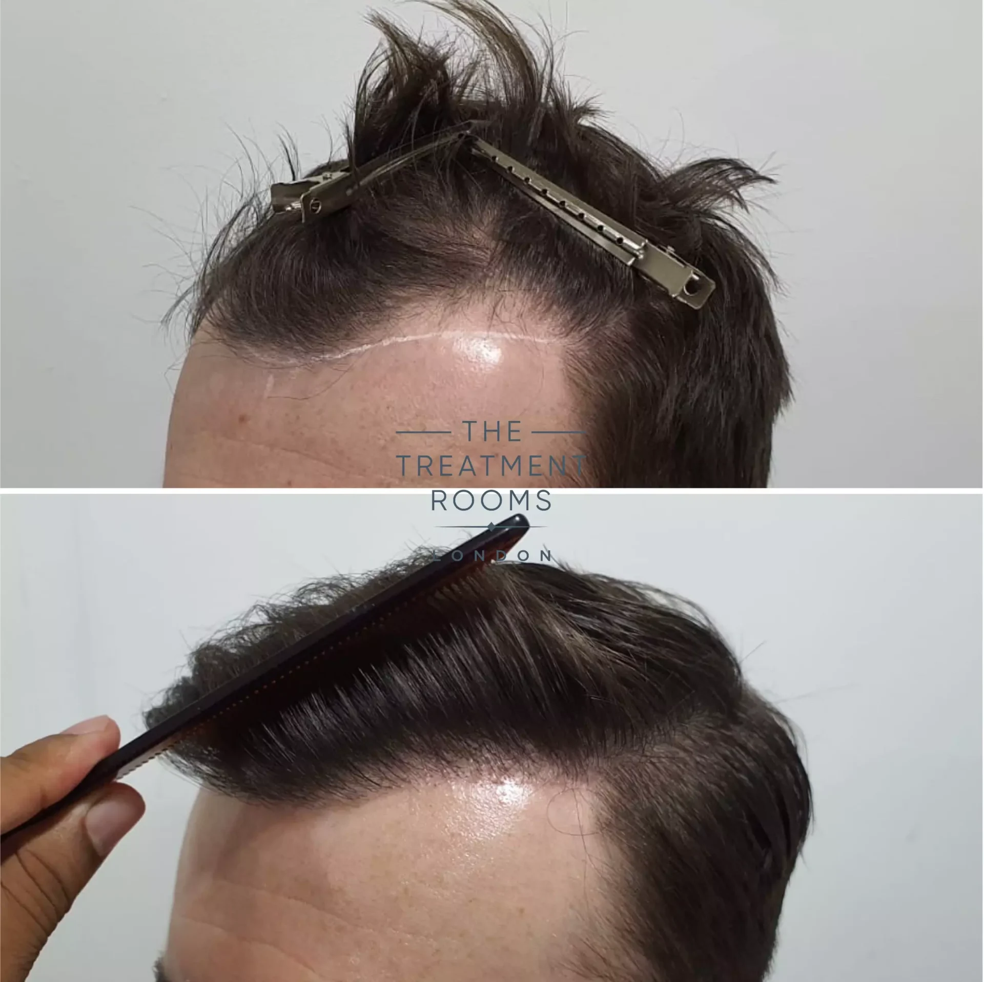 best hair transplant clinic uk 1014 grafts before and after