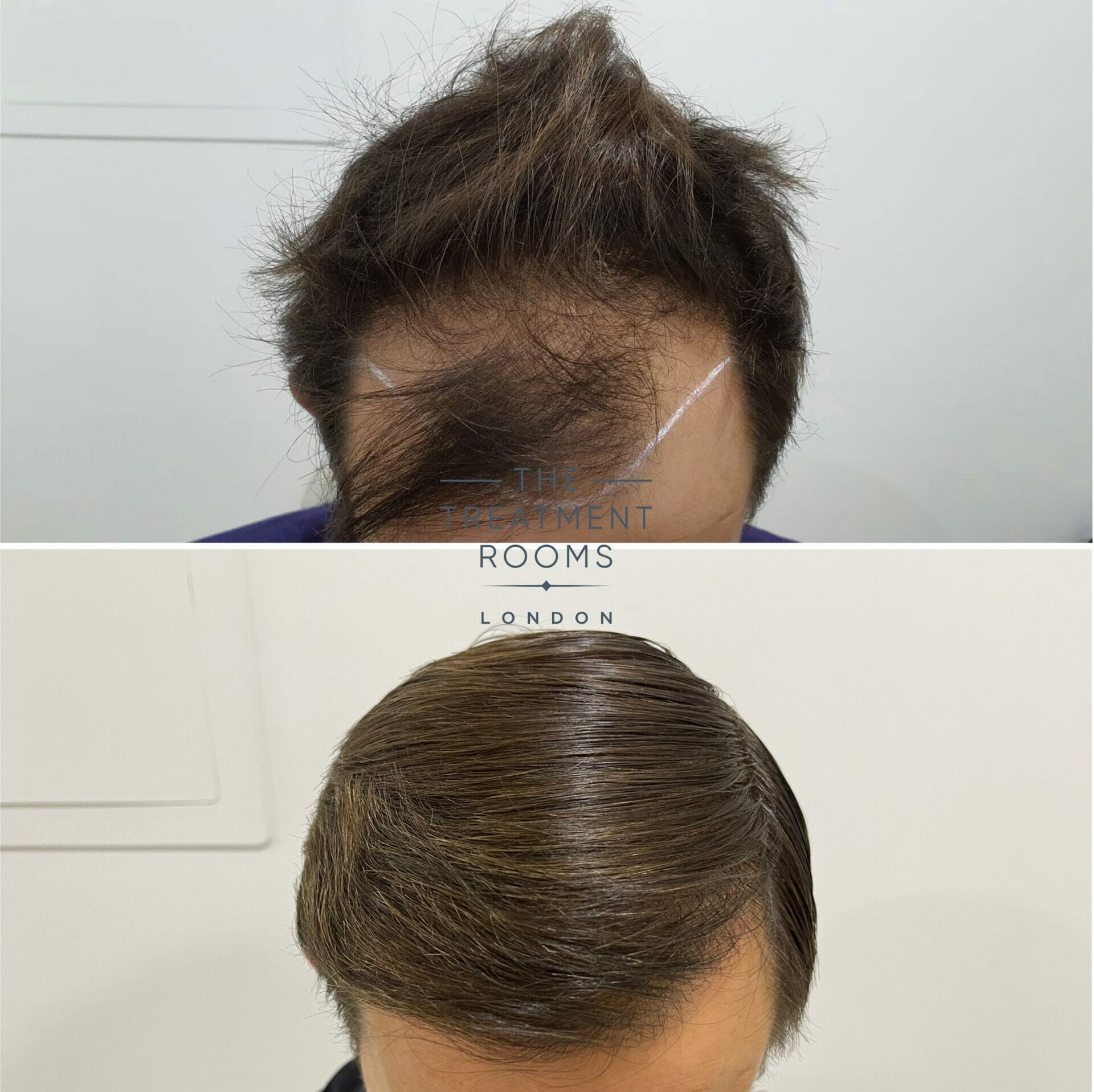 best hair transplant clinic uk before and after hair surgery