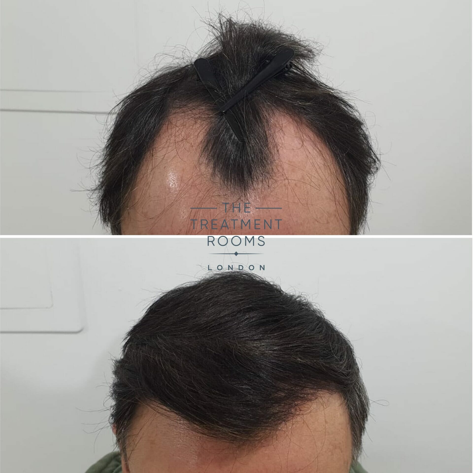 best hair transplant clinic uk before and after hairline surgery