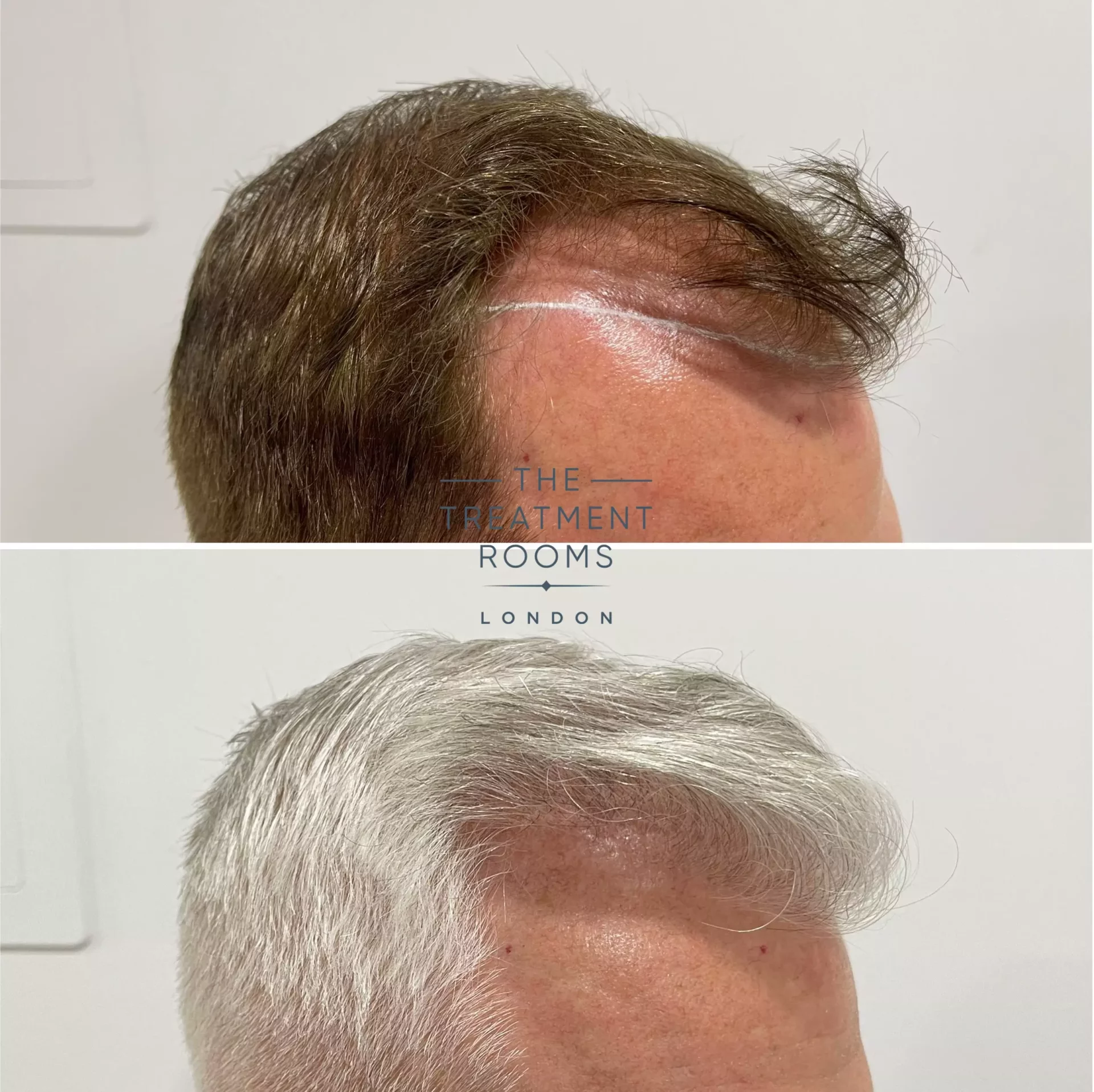 best hair transplant london 1495 grafts before and after
