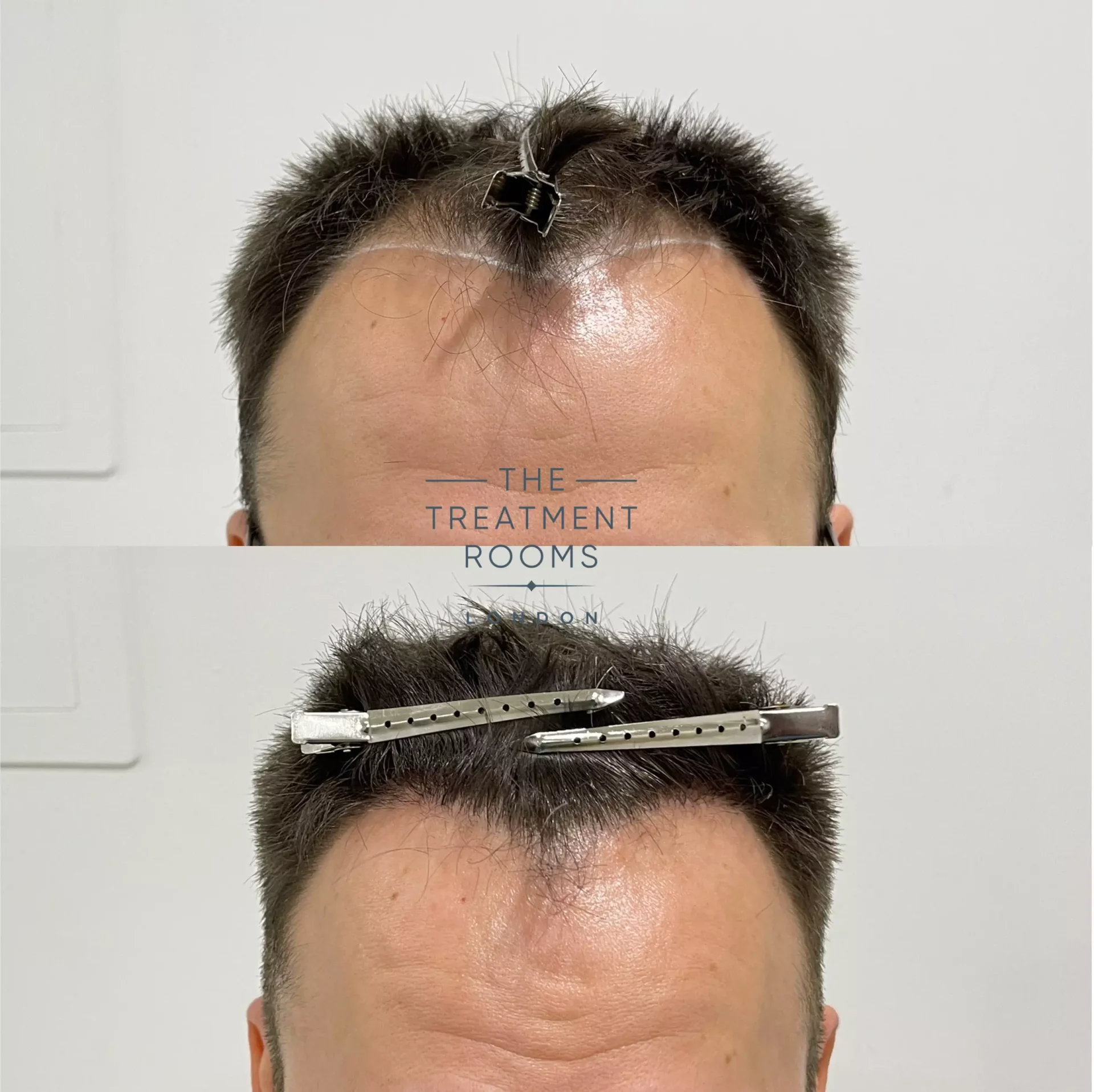 best hair transplant london 1930 grafts before and after