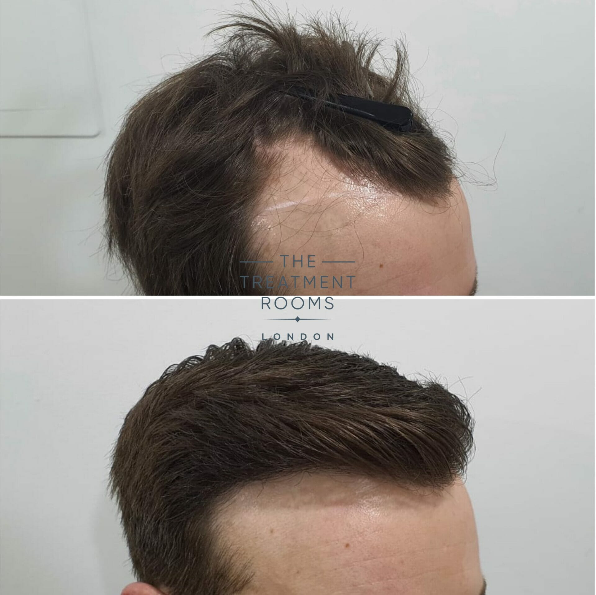 best hair transplant surgeon london before and after hairline surgery