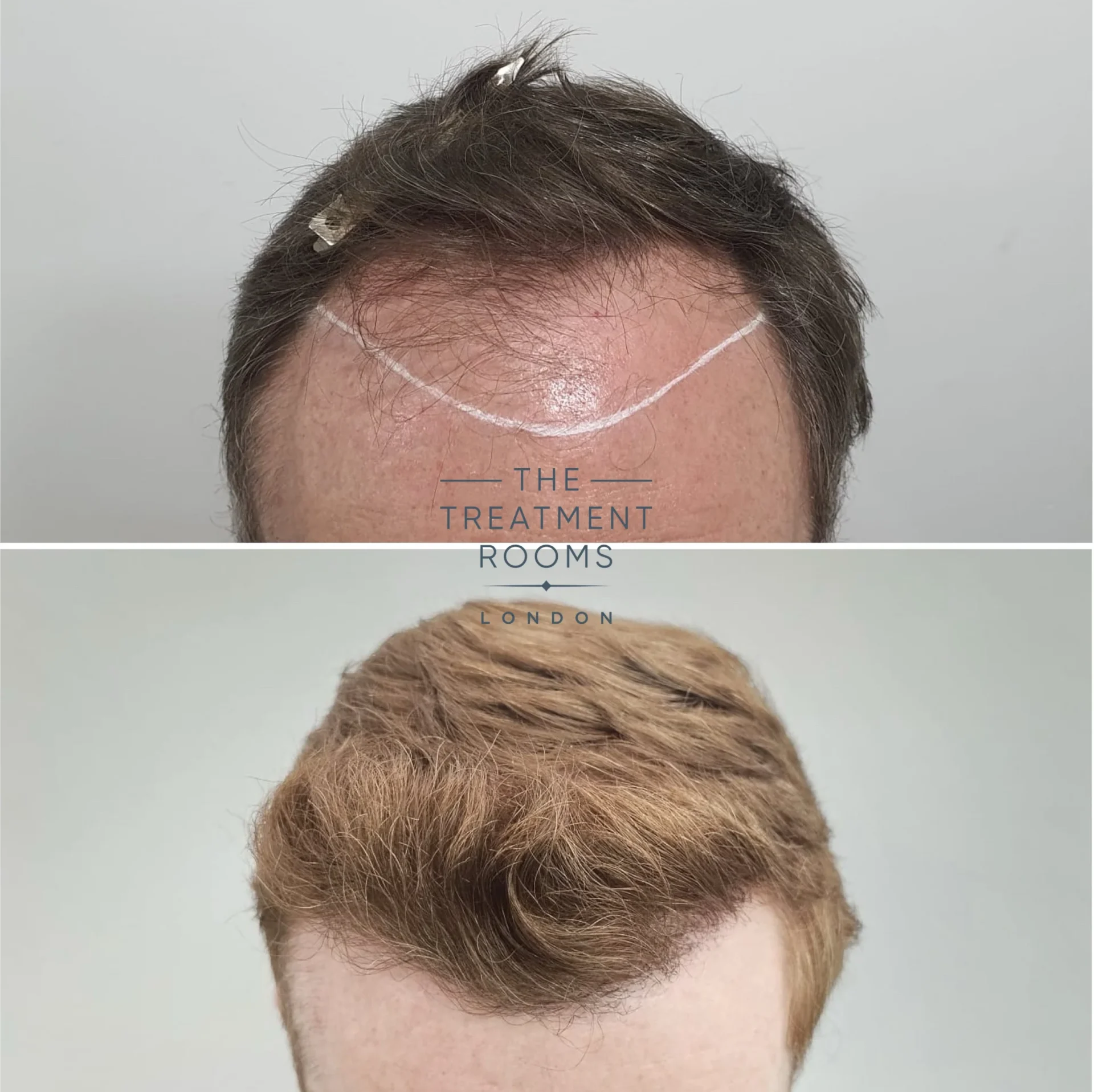 best hairline hair transplant clinic 2189 grafts before and after