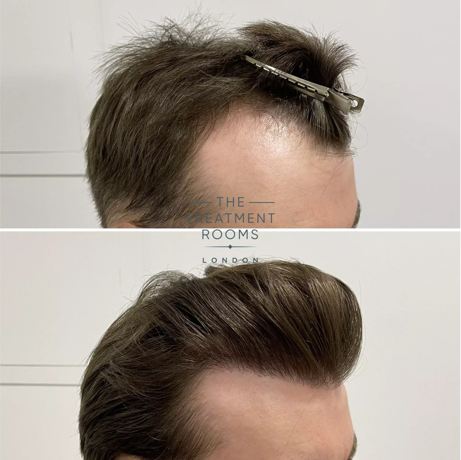 best hairline hair transplant clinic before and after 1357 grafts