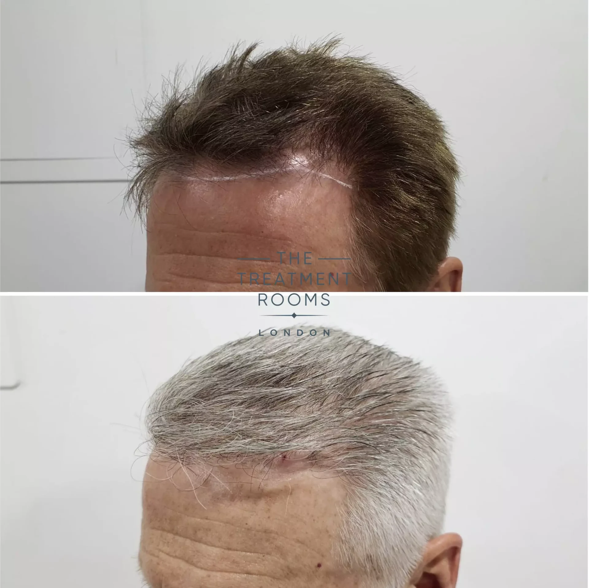 best hairline hair transplant clinic before and after